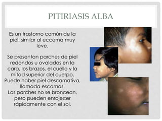PITIRIASIS ALBA
Es un trastorno común de la
piel, similar al eccema muy
leve.
Se presentan parches de piel
redondos u ovalados en la
cara, los brazos, el cuello y la
mitad superior del cuerpo.
Puede haber piel descamativa,
llamada escamas.
Los parches no se broncean,
pero pueden enrojecer
rápidamente con el sol.
 