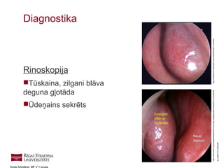 19
Anda Arbidāne, MF V 1.grupa
Rinoskopija
Tūskaina, zilgani blāva
deguna gļotāda
Ūdeņains sekrēts
Diagnostika
http://emedicine.medscape.com/article/834281-overviewhttp://www.eaaci.org/congresses/eaaci2015/clinical_village/posters/eaaci2015_clinicalvilla
ge_station13_nasal.pdf
 