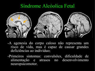 Síndrome Alcóolica Fetal -A agenesia do corpo caloso não representa um risco de vida, mas é capaz de causar grandes deficiências ao indivíduo; -Primeiros sintomas: convulsões, dificuldade de alimentação e atrasos no desenvolvimento neuropsicomotor. 