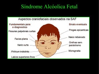Síndrome Alcóolica Fetal 