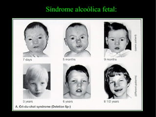 Síndrome alcoólica fetal: 