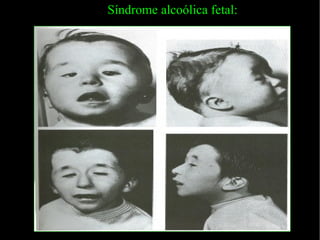 Síndrome alcoólica fetal: 