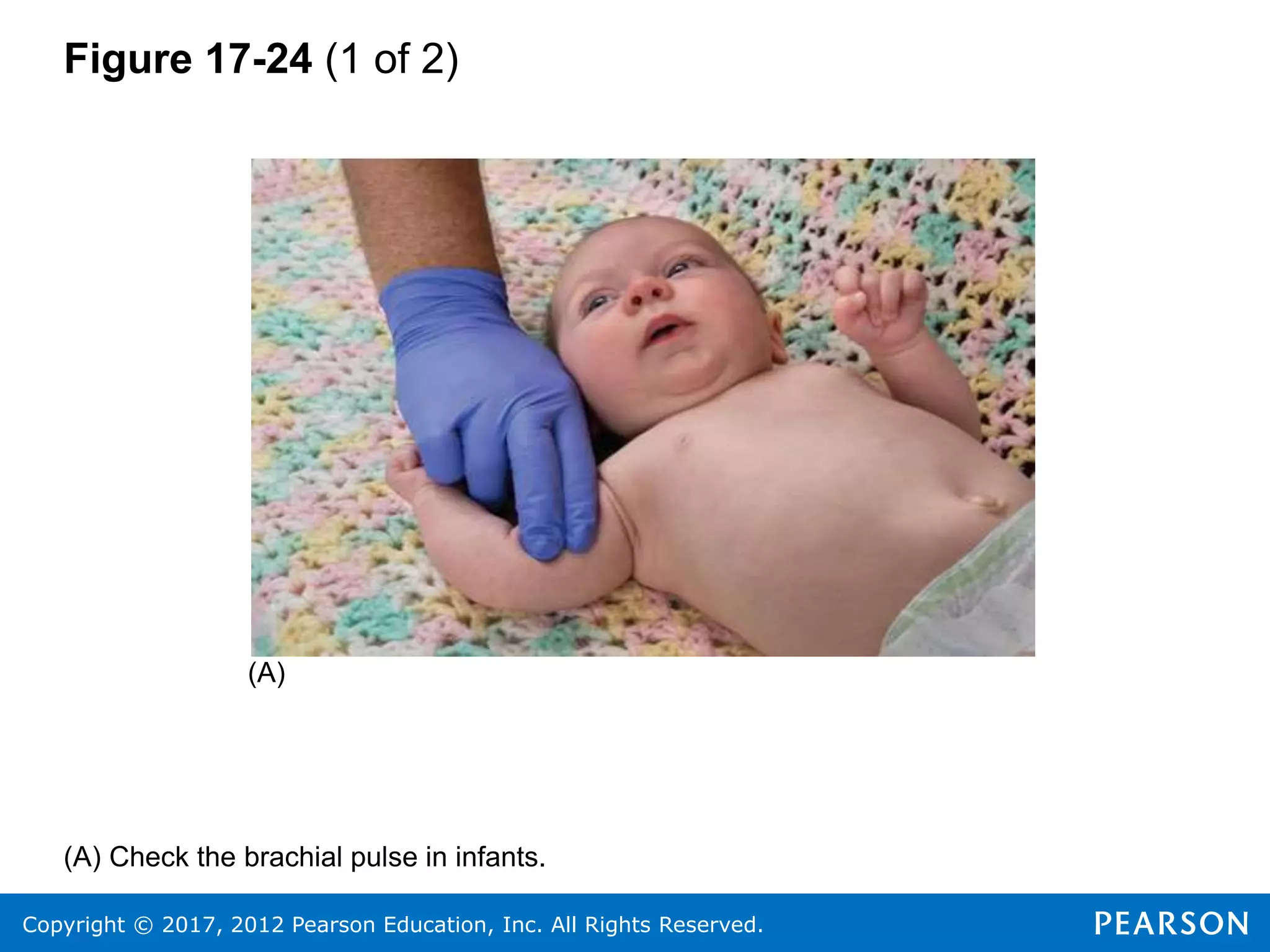 Copyright © 2017, 2012 Pearson Education, Inc. All Rights Reserved.
Figure 17-24 (1 of 2)
(A)
(A) Check the brachial pulse in infants.
 