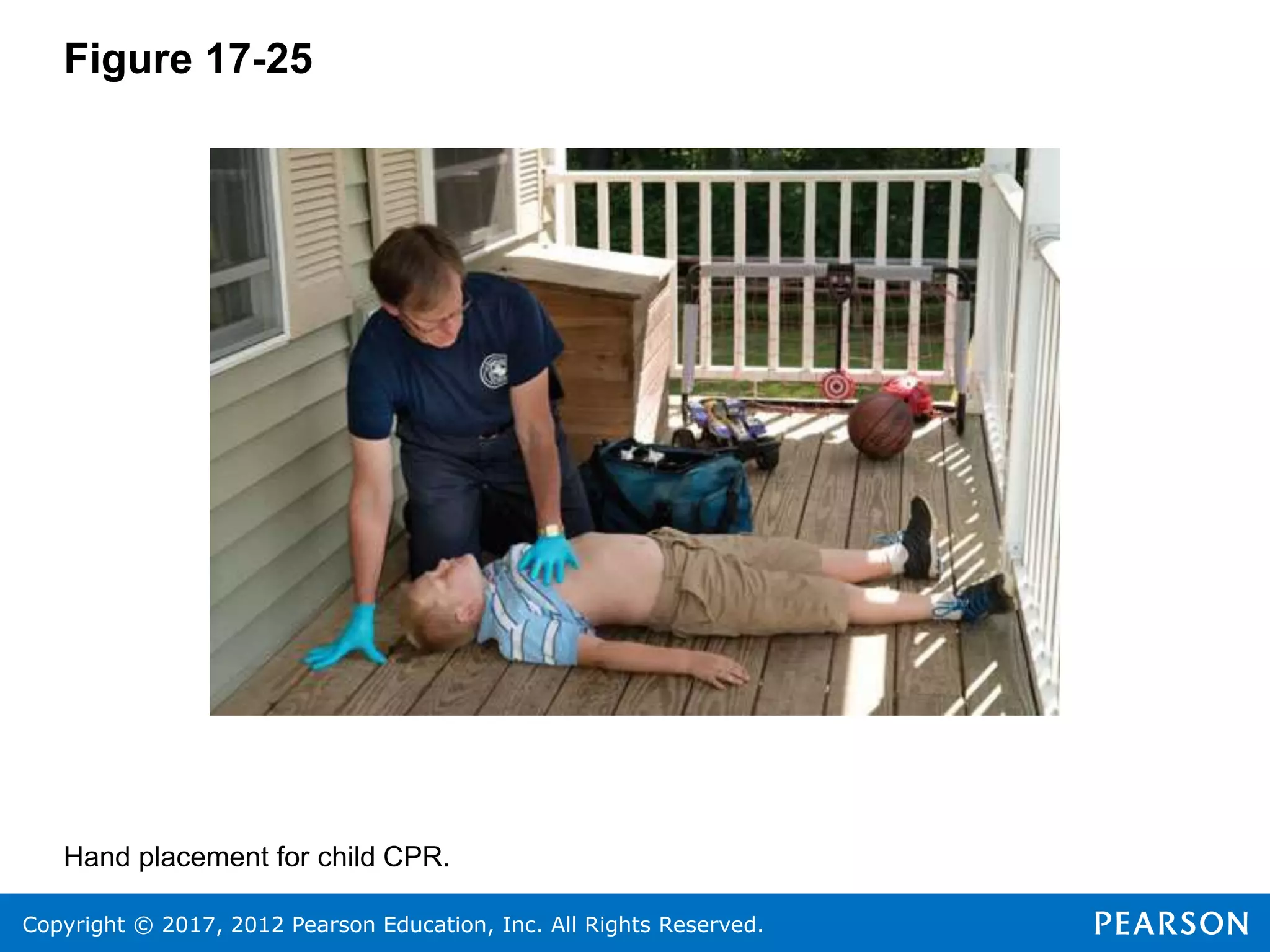 Copyright © 2017, 2012 Pearson Education, Inc. All Rights Reserved.
Figure 17-25
Hand placement for child CPR.
 