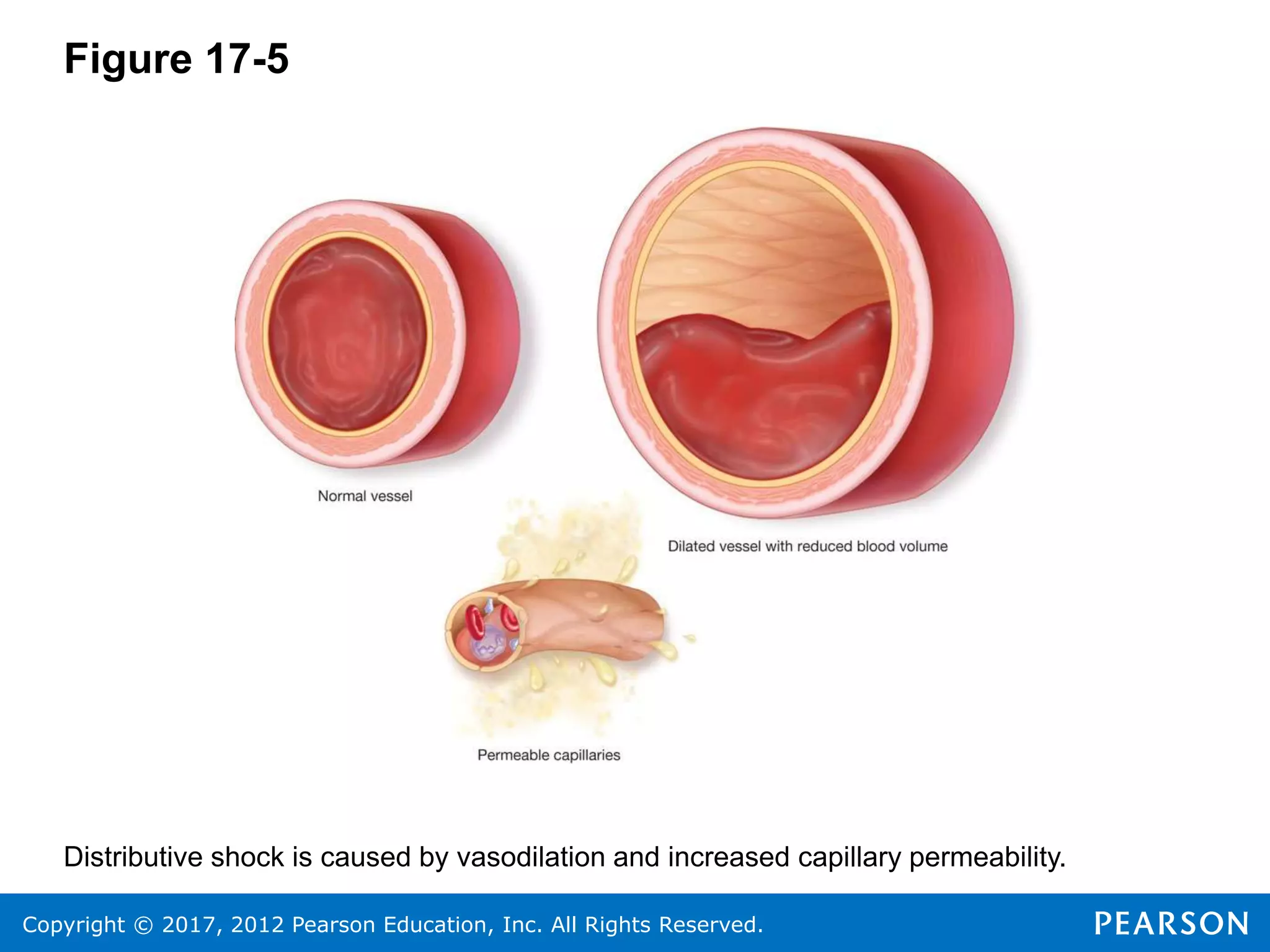 Copyright © 2017, 2012 Pearson Education, Inc. All Rights Reserved.
Figure 17-5
Distributive shock is caused by vasodilation and increased capillary permeability.
 