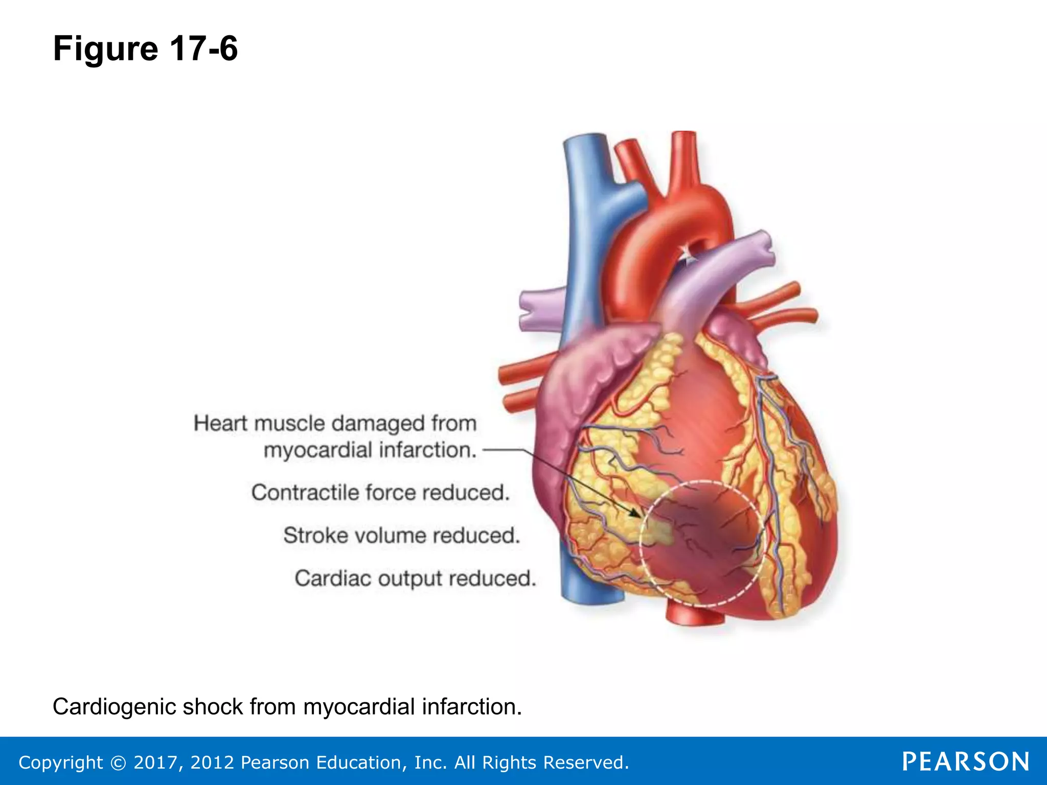 Copyright © 2017, 2012 Pearson Education, Inc. All Rights Reserved.
Figure 17-6
Cardiogenic shock from myocardial infarction.
 
