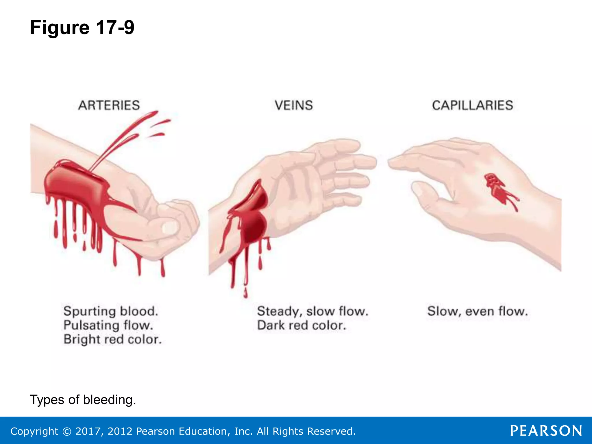 Copyright © 2017, 2012 Pearson Education, Inc. All Rights Reserved.
Figure 17-9
Types of bleeding.
 