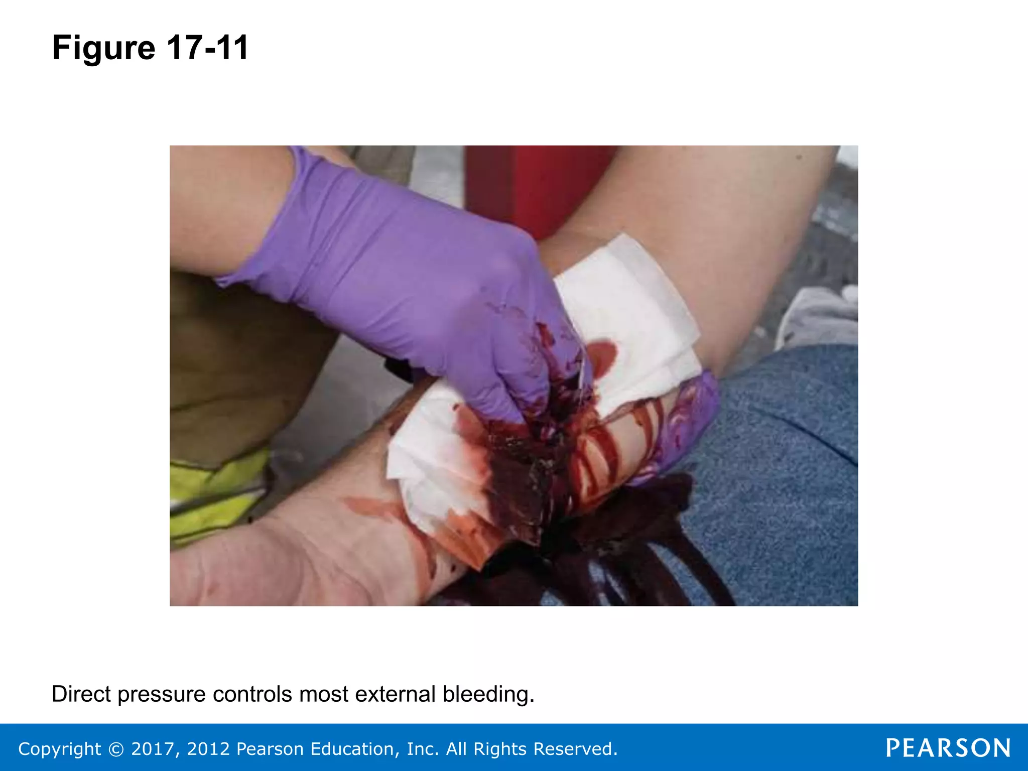 Copyright © 2017, 2012 Pearson Education, Inc. All Rights Reserved.
Figure 17-11
Direct pressure controls most external bleeding.
 