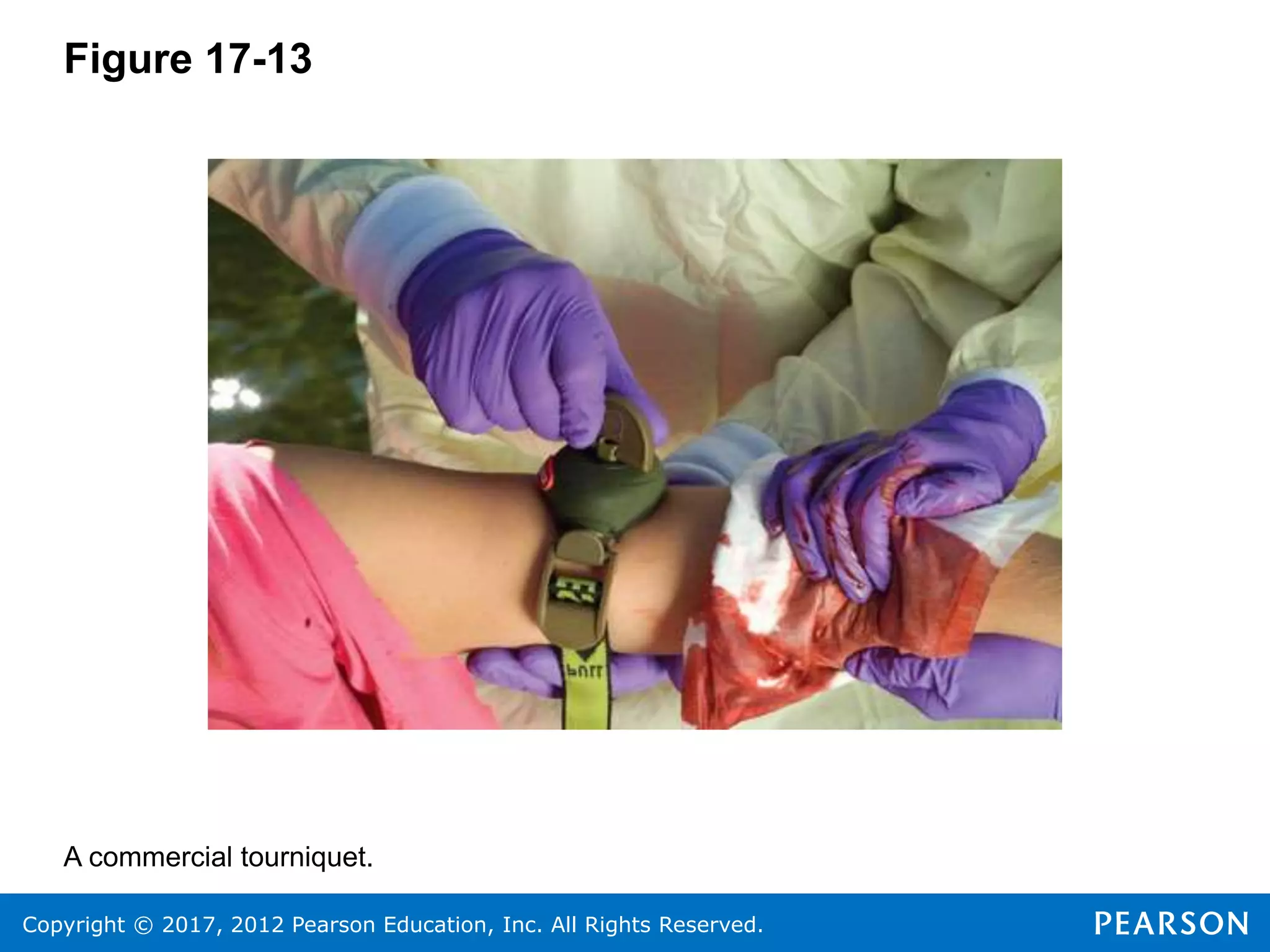 Copyright © 2017, 2012 Pearson Education, Inc. All Rights Reserved.
Figure 17-13
A commercial tourniquet.
 