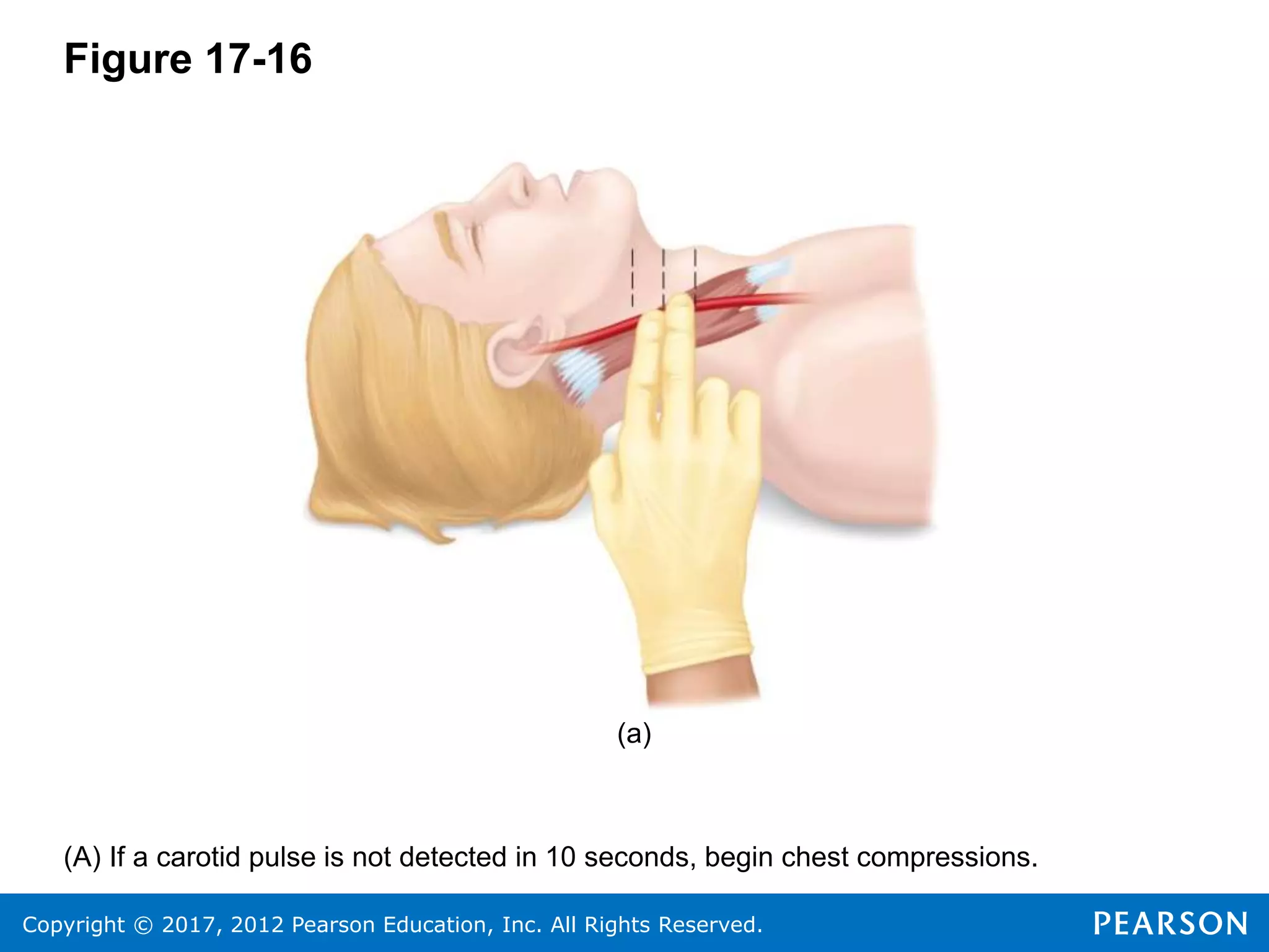 Copyright © 2017, 2012 Pearson Education, Inc. All Rights Reserved.
Figure 17-16
(a)
(A) If a carotid pulse is not detected in 10 seconds, begin chest compressions.
 
