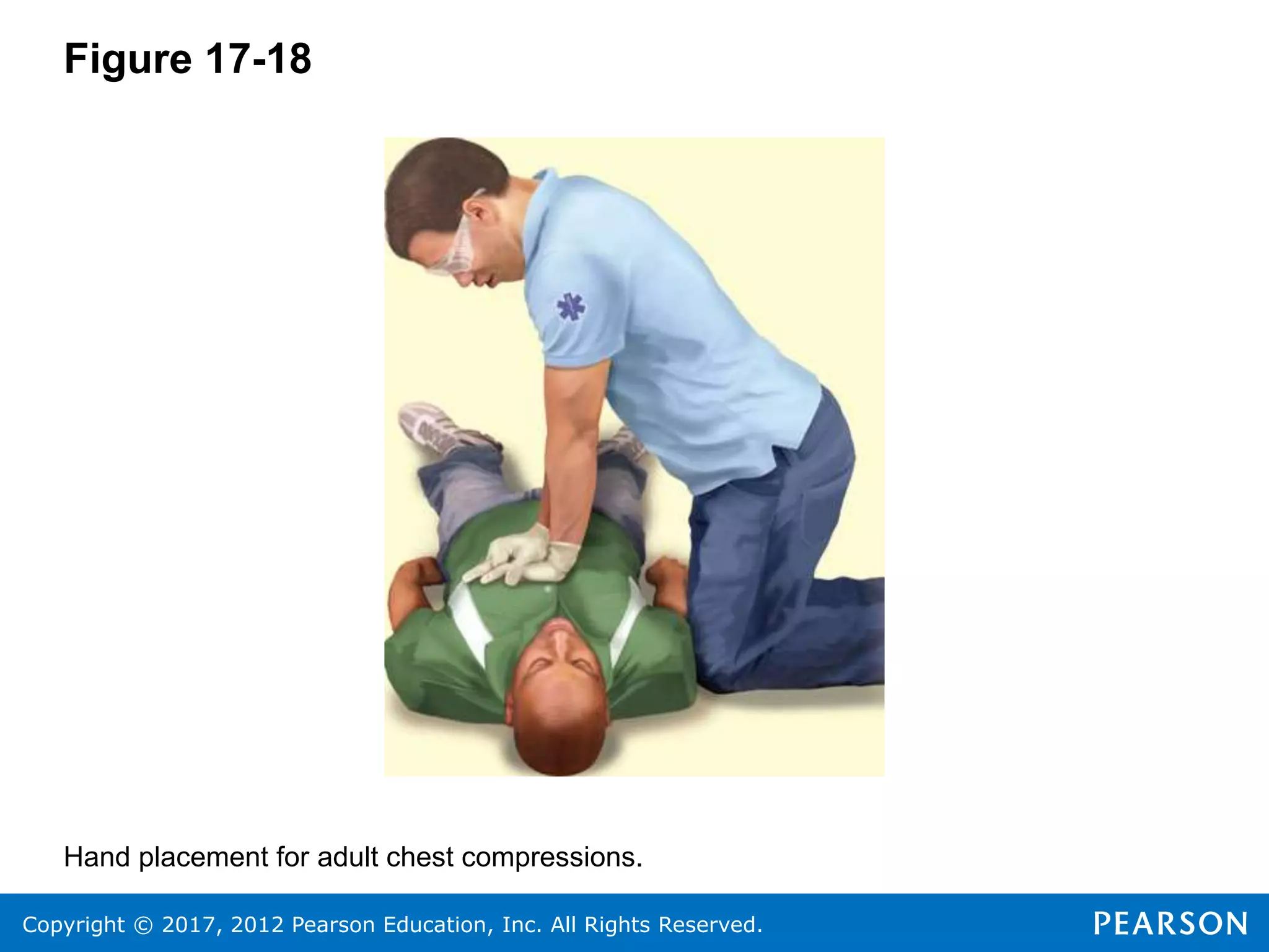 Copyright © 2017, 2012 Pearson Education, Inc. All Rights Reserved.
Figure 17-18
Hand placement for adult chest compressions.
 