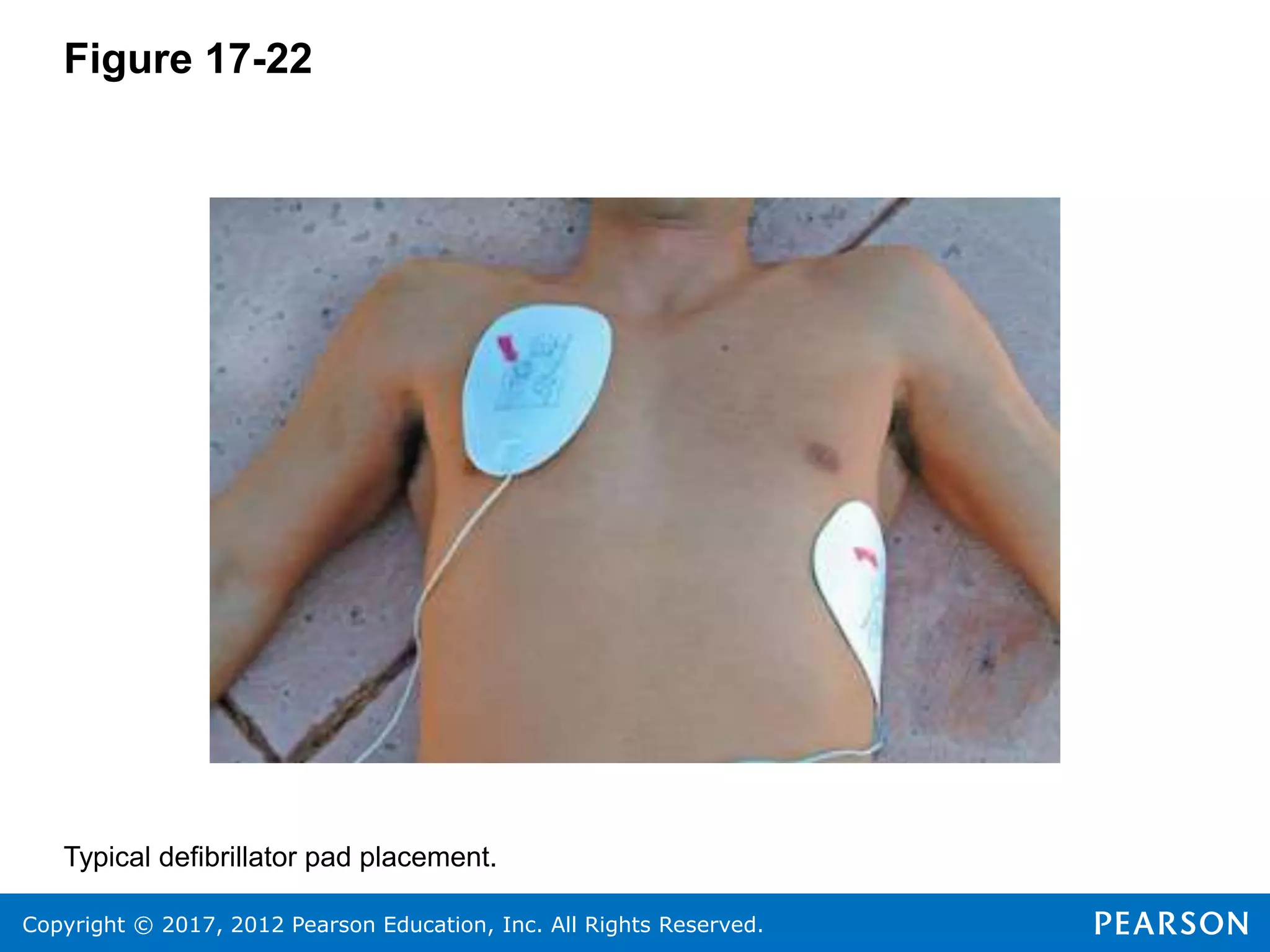 Copyright © 2017, 2012 Pearson Education, Inc. All Rights Reserved.
Figure 17-22
Typical defibrillator pad placement.
 