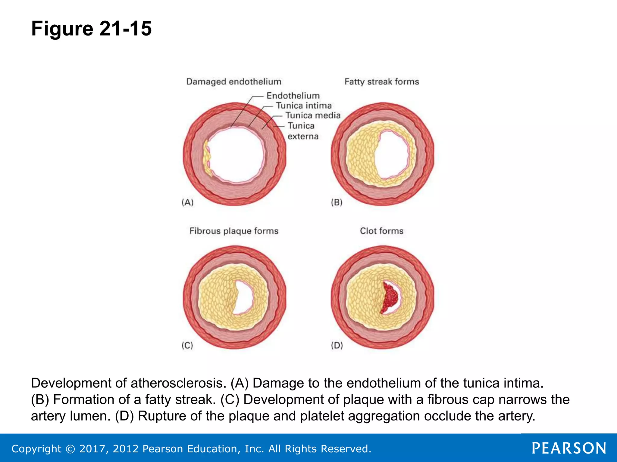 Copyright © 2017, 2012 Pearson Education, Inc. All Rights Reserved.
Figure 21-15
Development of atherosclerosis. (A) Damage to the endothelium of the tunica intima.
(B) Formation of a fatty streak. (C) Development of plaque with a fibrous cap narrows the
artery lumen. (D) Rupture of the plaque and platelet aggregation occlude the artery.
 