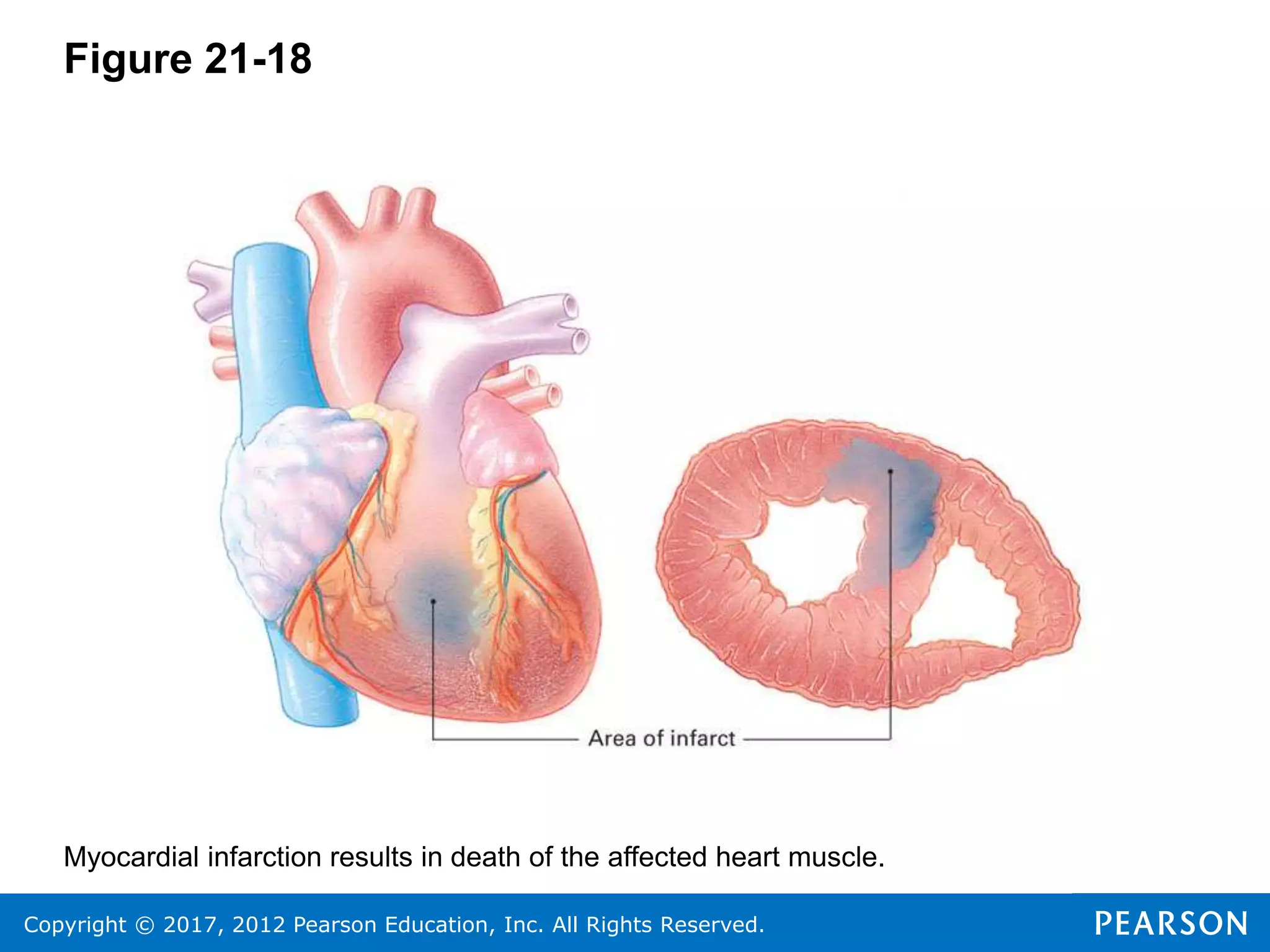 Copyright © 2017, 2012 Pearson Education, Inc. All Rights Reserved.
Figure 21-18
Myocardial infarction results in death of the affected heart muscle.
 