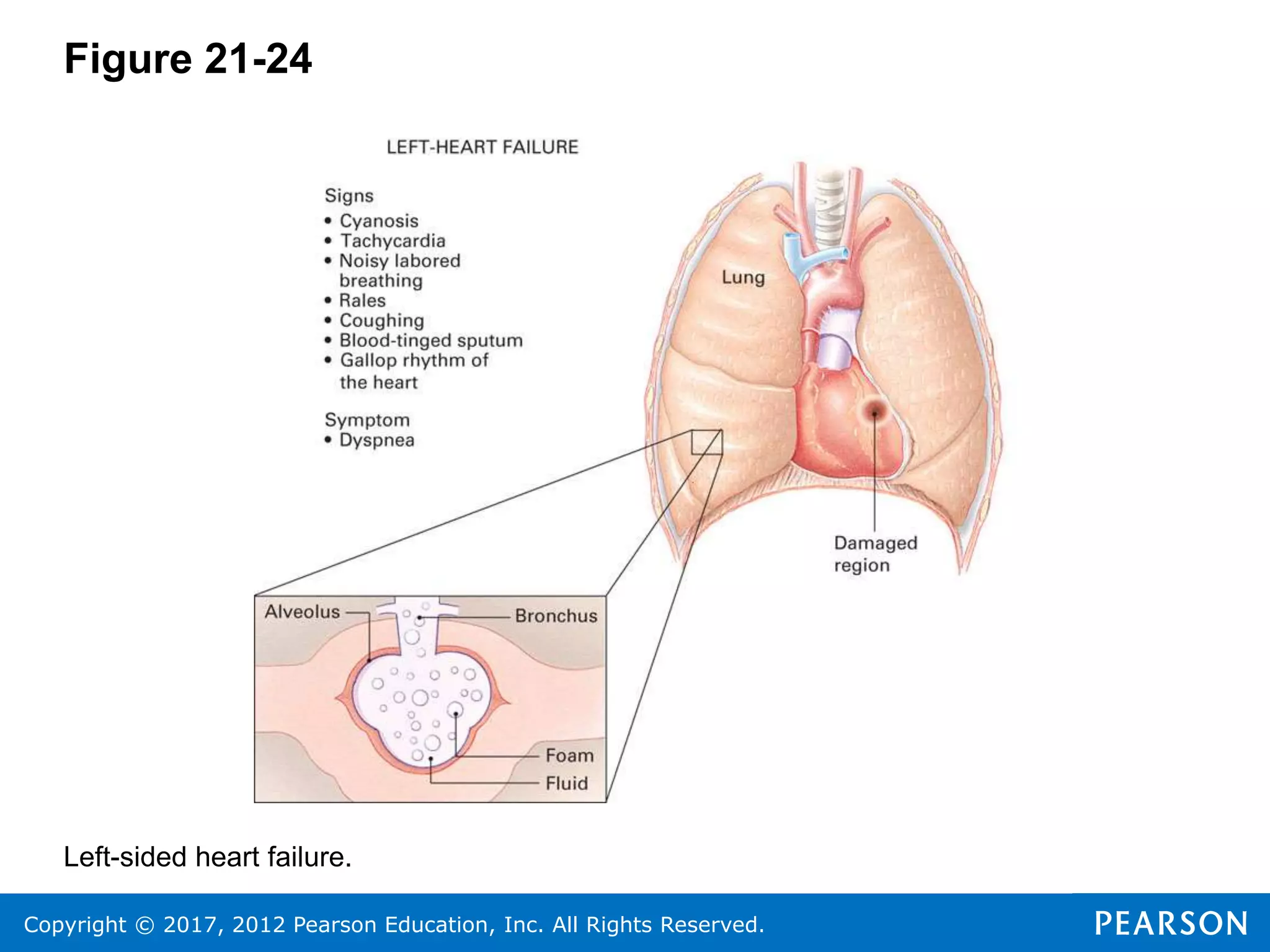 Copyright © 2017, 2012 Pearson Education, Inc. All Rights Reserved.
Figure 21-24
Left-sided heart failure.
 