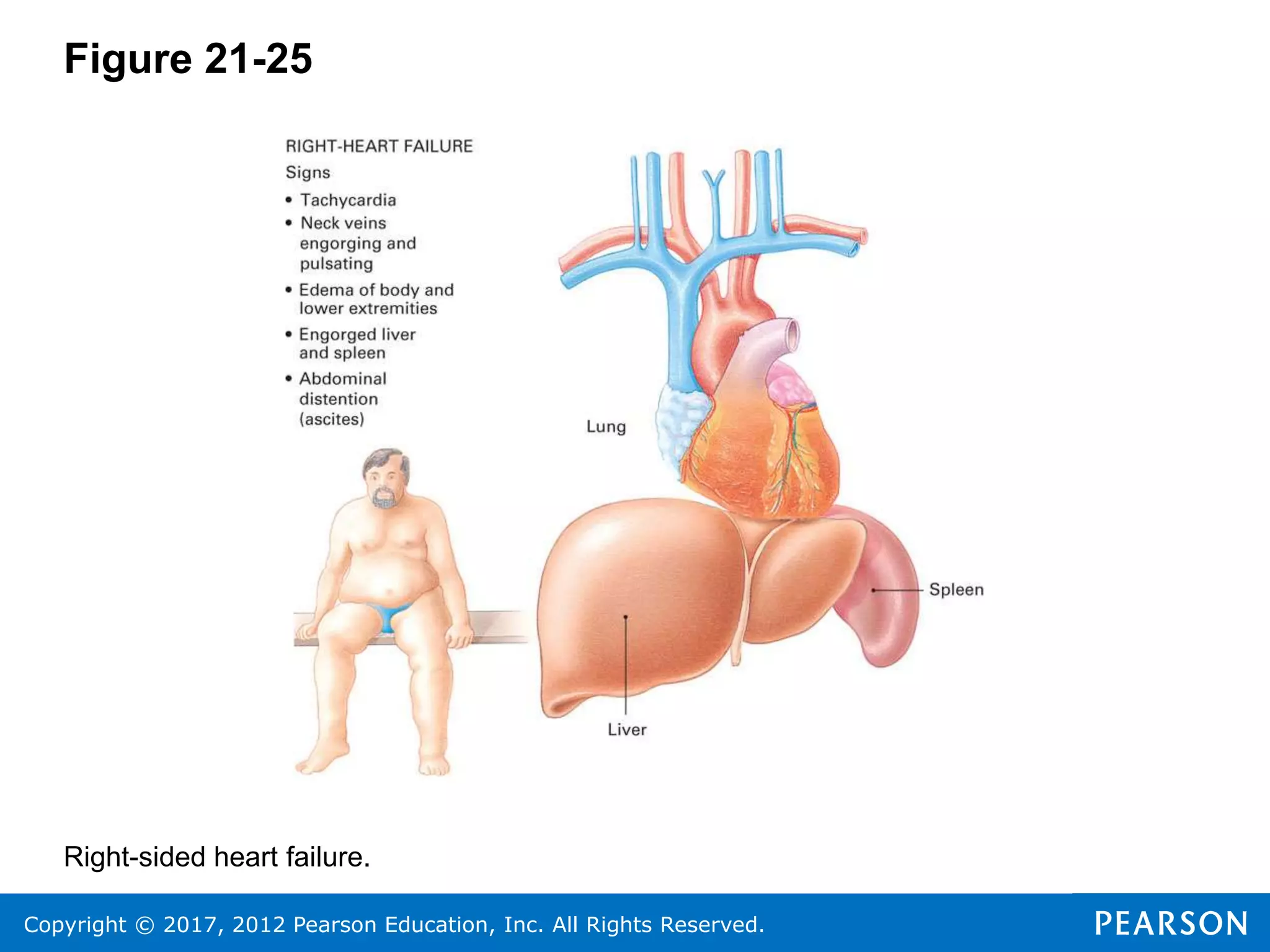 Copyright © 2017, 2012 Pearson Education, Inc. All Rights Reserved.
Figure 21-25
Right-sided heart failure.
 
