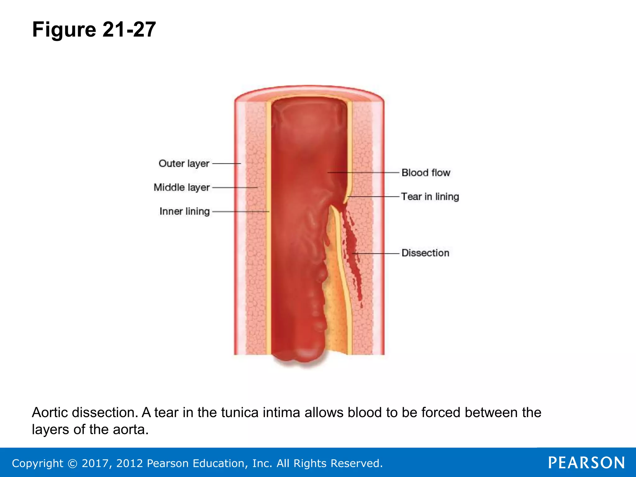 Copyright © 2017, 2012 Pearson Education, Inc. All Rights Reserved.
Figure 21-27
Aortic dissection. A tear in the tunica intima allows blood to be forced between the
layers of the aorta.
 