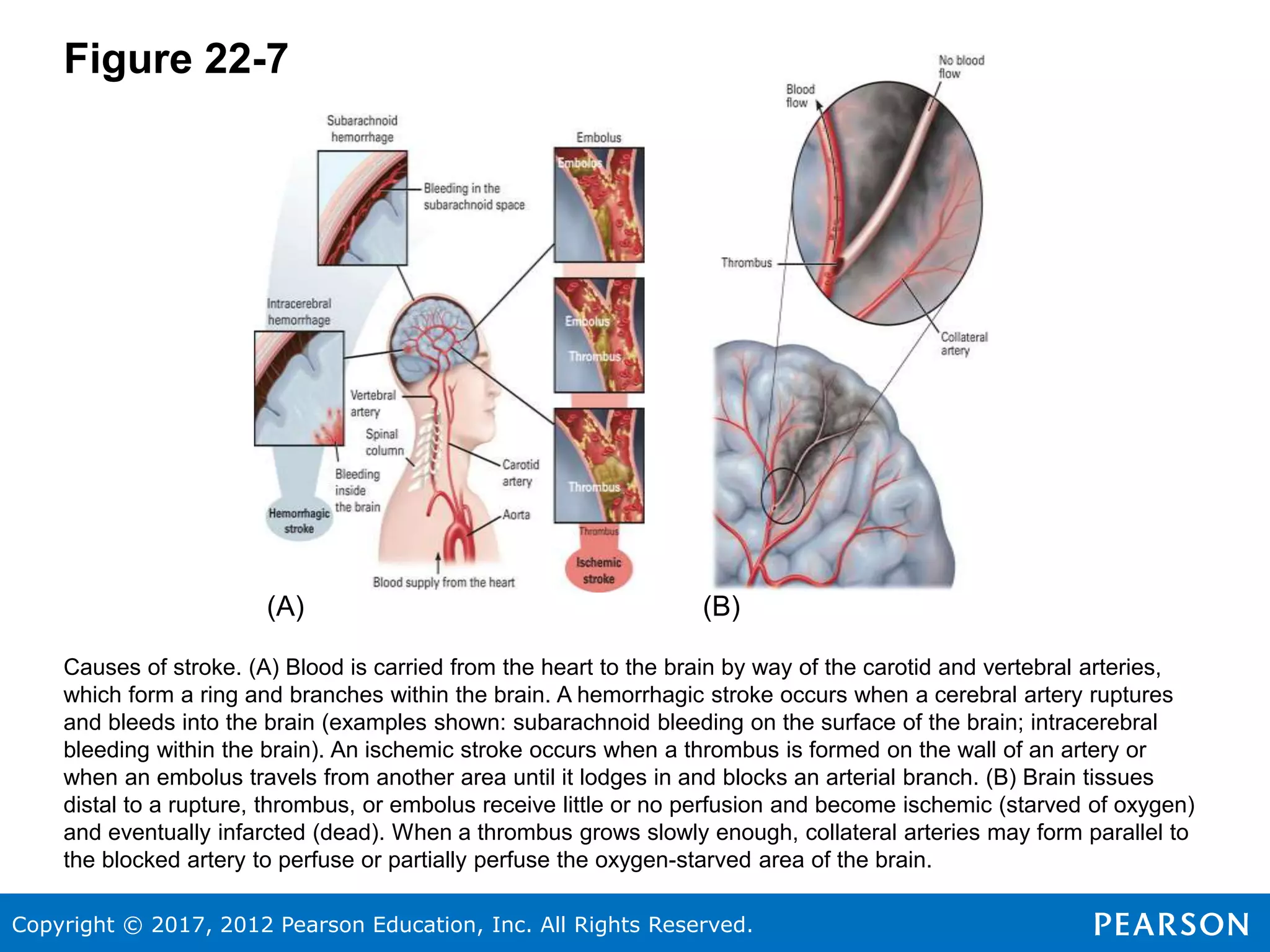 Copyright © 2017, 2012 Pearson Education, Inc. All Rights Reserved.
Figure 22-7
(A) (B)
Causes of stroke. (A) Blood is carried from the heart to the brain by way of the carotid and vertebral arteries,
which form a ring and branches within the brain. A hemorrhagic stroke occurs when a cerebral artery ruptures
and bleeds into the brain (examples shown: subarachnoid bleeding on the surface of the brain; intracerebral
bleeding within the brain). An ischemic stroke occurs when a thrombus is formed on the wall of an artery or
when an embolus travels from another area until it lodges in and blocks an arterial branch. (B) Brain tissues
distal to a rupture, thrombus, or embolus receive little or no perfusion and become ischemic (starved of oxygen)
and eventually infarcted (dead). When a thrombus grows slowly enough, collateral arteries may form parallel to
the blocked artery to perfuse or partially perfuse the oxygen-starved area of the brain.
 