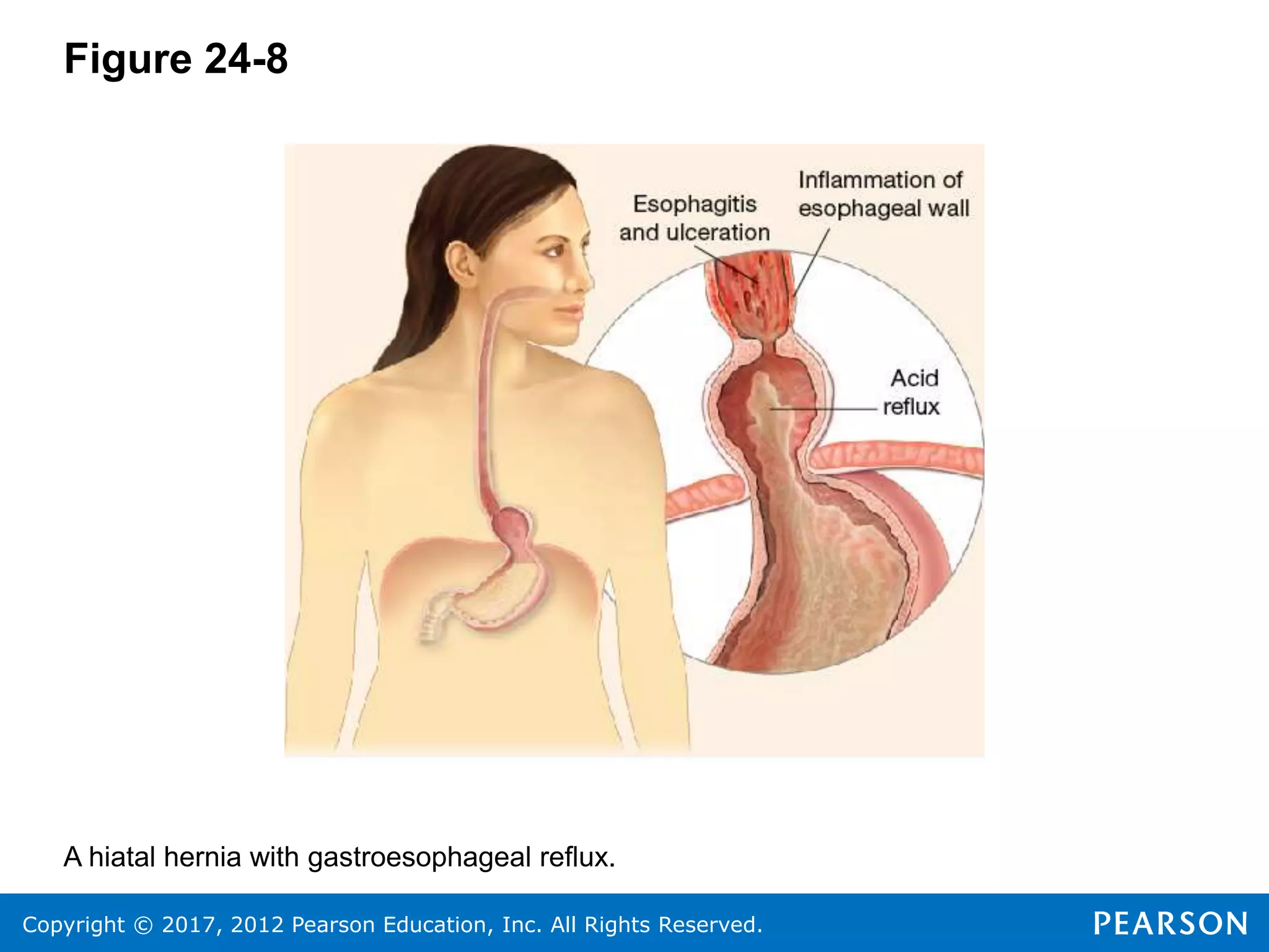 Copyright © 2017, 2012 Pearson Education, Inc. All Rights Reserved.
Figure 24-8
A hiatal hernia with gastroesophageal reflux.
 