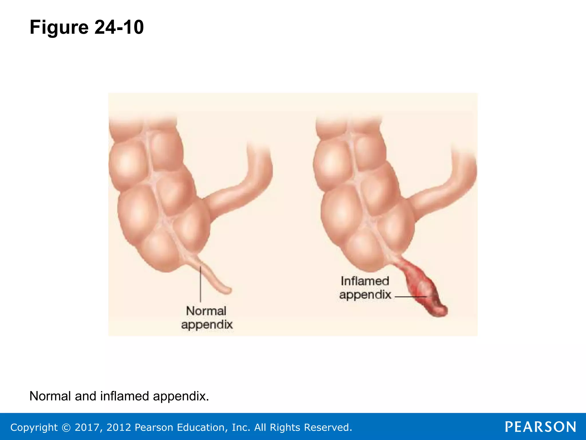 Copyright © 2017, 2012 Pearson Education, Inc. All Rights Reserved.
Figure 24-10
Normal and inflamed appendix.
 