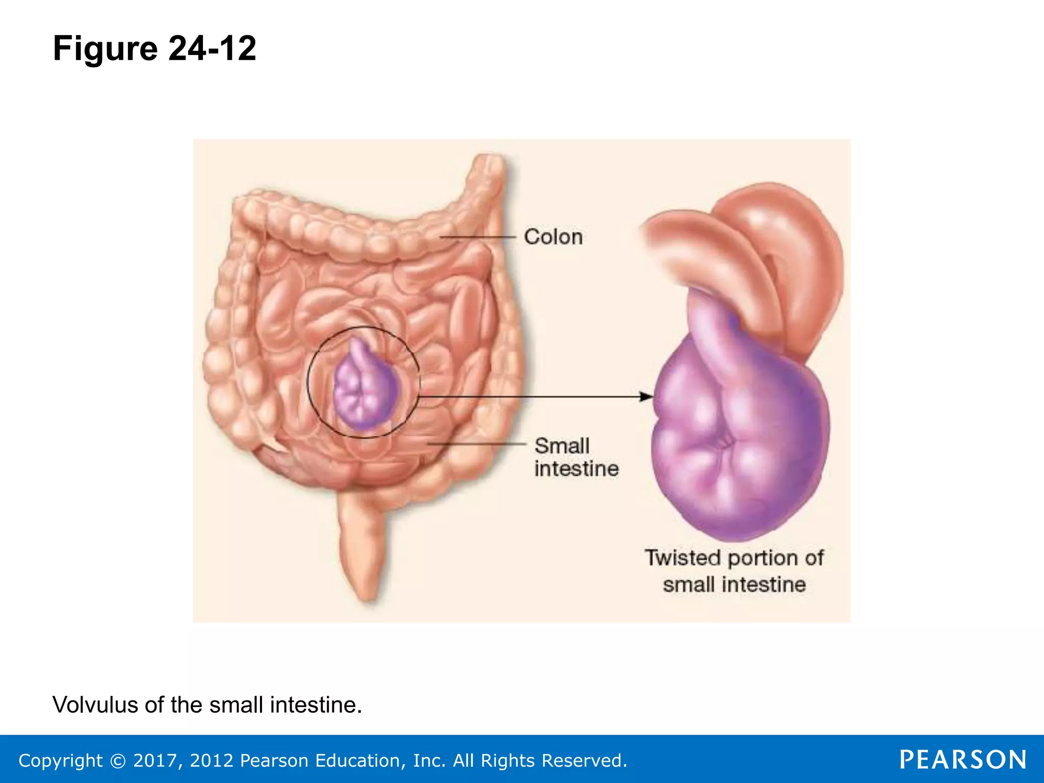 Copyright © 2017, 2012 Pearson Education, Inc. All Rights Reserved.
Figure 24-12
Volvulus of the small intestine.
 