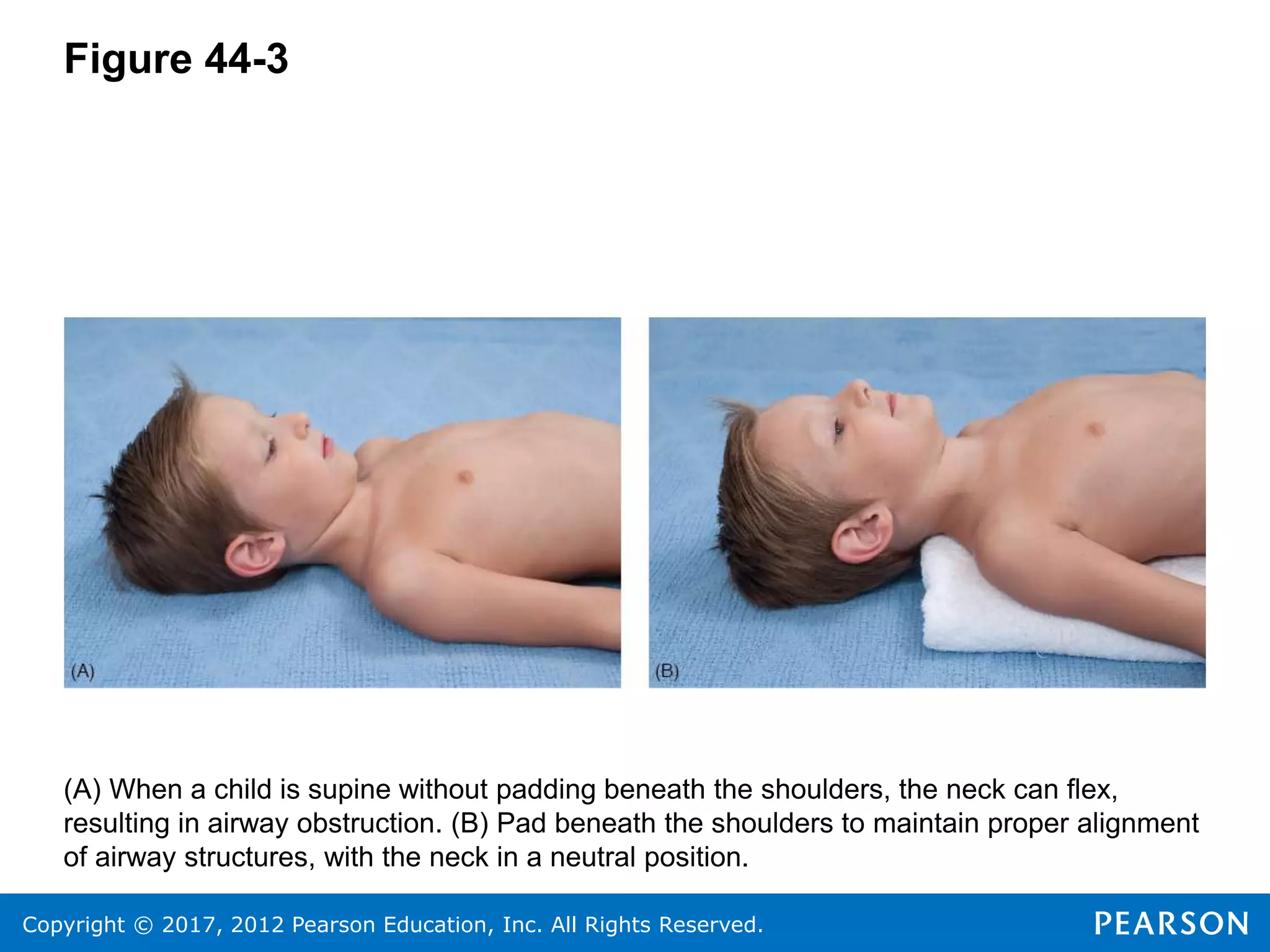 Copyright © 2017, 2012 Pearson Education, Inc. All Rights Reserved.
Figure 44-3
(A) When a child is supine without padding beneath the shoulders, the neck can flex,
resulting in airway obstruction. (B) Pad beneath the shoulders to maintain proper alignment
of airway structures, with the neck in a neutral position.
 