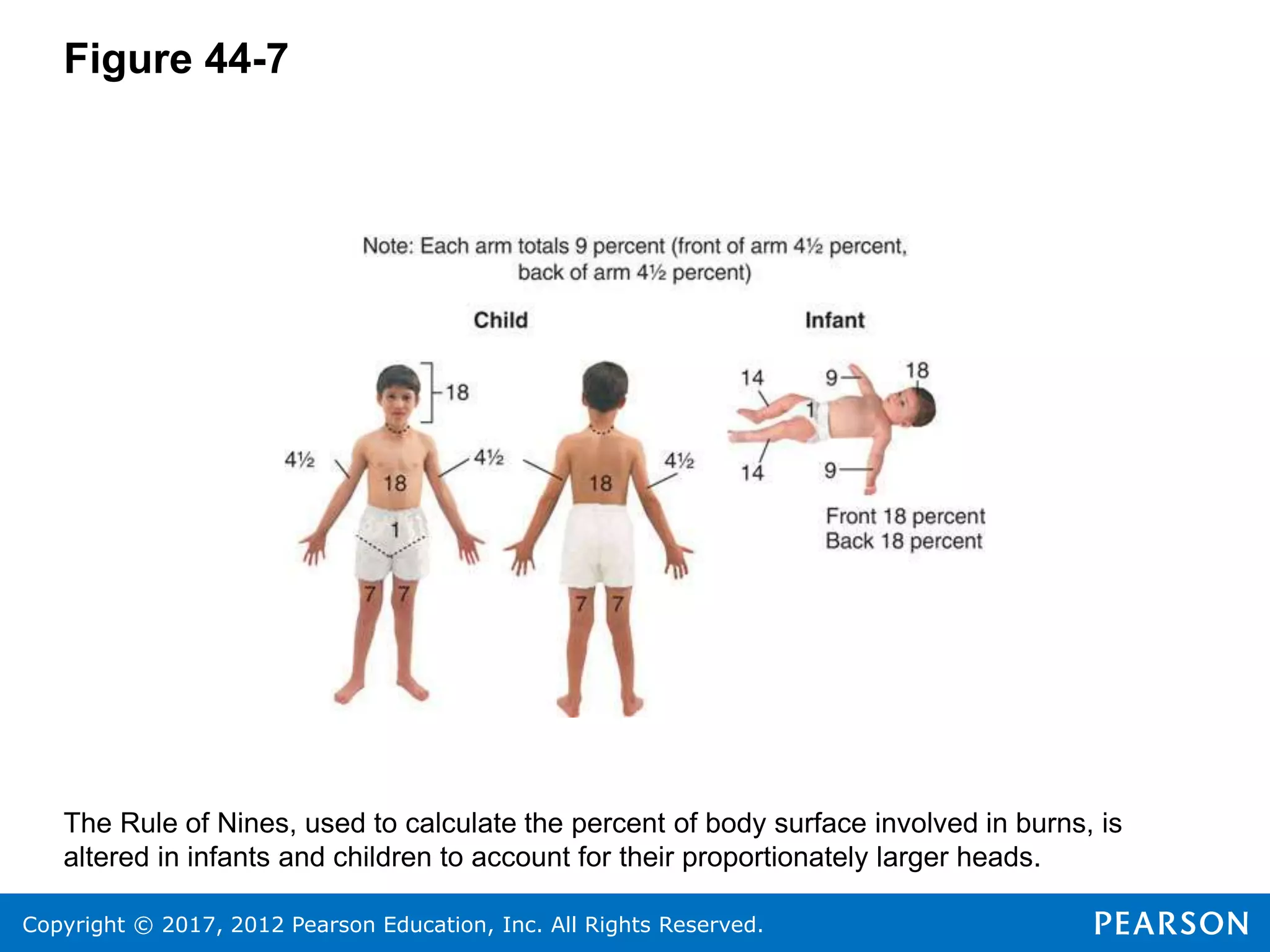 Copyright © 2017, 2012 Pearson Education, Inc. All Rights Reserved.
Figure 44-7
The Rule of Nines, used to calculate the percent of body surface involved in burns, is
altered in infants and children to account for their proportionately larger heads.
 