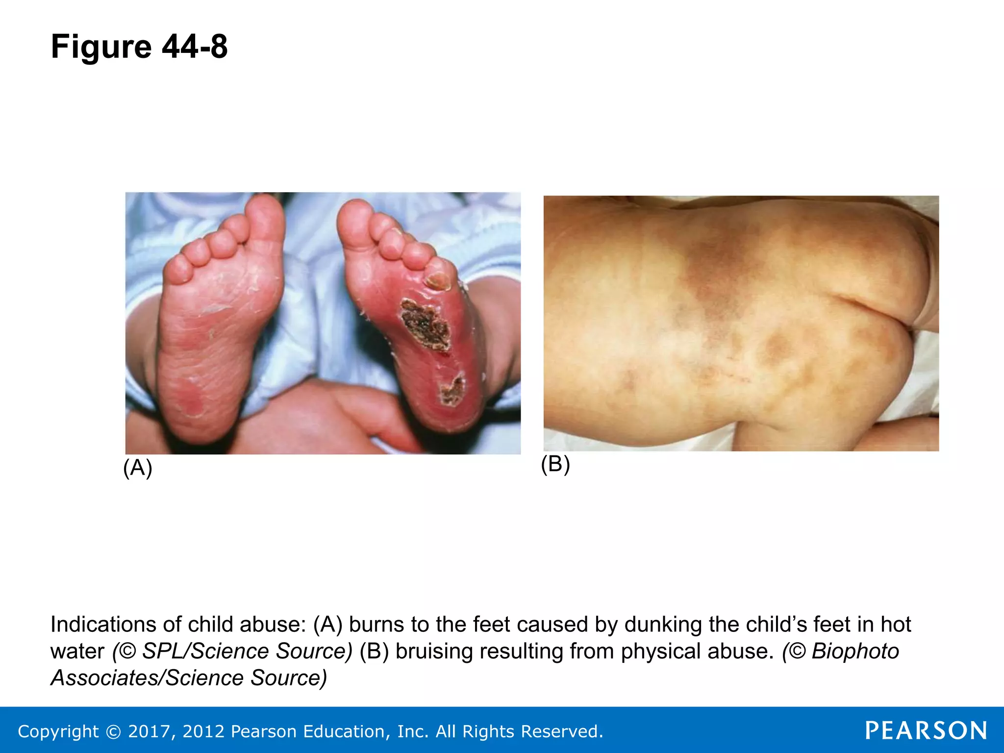 Copyright © 2017, 2012 Pearson Education, Inc. All Rights Reserved.
Figure 44-8
Indications of child abuse: (A) burns to the feet caused by dunking the child’s feet in hot
water (© SPL/Science Source) (B) bruising resulting from physical abuse. (© Biophoto
Associates/Science Source)
(A) (B)
 