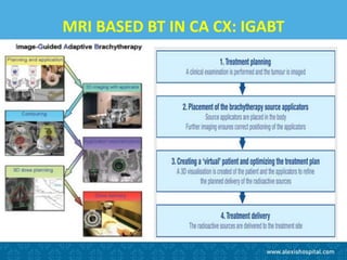 MRI BASED BT IN CA CX: IGABT
 