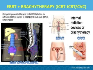 EBRT + BRACHYTHERAPY (ICBT-ICRT/CVC)
 