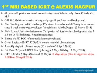 1ST MRI BASED ICRT @ ALEXIS NAGPUR
 61 year old postmenopausal normotensive non-diabetic lady from Chindwada,
M.P
 G5P5A0 Multipara married at very early age 11 yrs from rural background.
 P/w Bleeding and white discharge P/V since 1 months and difficulty in urination
since 1 week came to gynecologist for opinion at Alexis, Nagpur (5 March 2018)
 P/s/v Exam: Ulcerative lesion over Cx lip with left fornices involved growth size 5
x 4 cm Lt PM indurated. Rectal mucosa free.
 Biopsy s/o PD SCC refer to radiation oncologist and
 Given Rapidarc IMRT 50 Gy/25# concurrent with chemotherapy
 5 weekly cisplatin chemotherapy (15 march to 20 April 2018)
 3# Dose 7 Gy each ICRT Brachytherapy ( 3 May, 10 May, 17 May 2018) ;
 OTT = 8 wks 2 Days (Standard 56 Days) +2 days delay (Due to Approval delay
AERB on 28 April 2018)
 