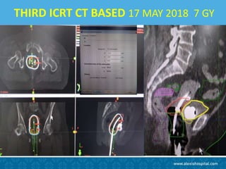 THIRD ICRT CT BASED 17 MAY 2018 7 GY
 