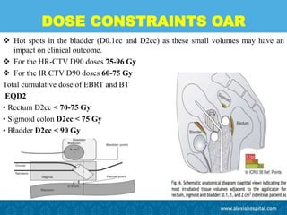 DOSE CONSTRAINTS OAR
 Hot spots in the bladder (D0.1cc and D2cc) as these small volumes may have an
impact on clinical outcome.
 For the HR-CTV D90 doses 75-96 Gy
 For the IR CTV D90 doses 60-75 Gy
Total cumulative dose of EBRT and BT
EQD2
• Rectum D2cc < 70-75 Gy
• Sigmoid colon D2cc < 75 Gy
• Bladder D2cc < 90 Gy
 