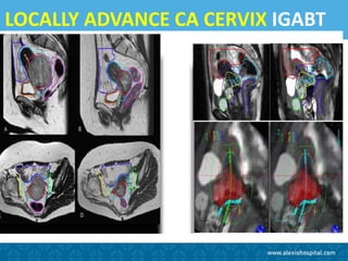 LOCALLY ADVANCE CA CERVIX IGABT
 