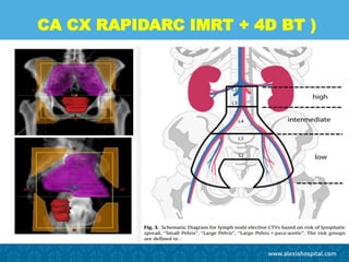 CA CX RAPIDARC IMRT + 4D BT )
 