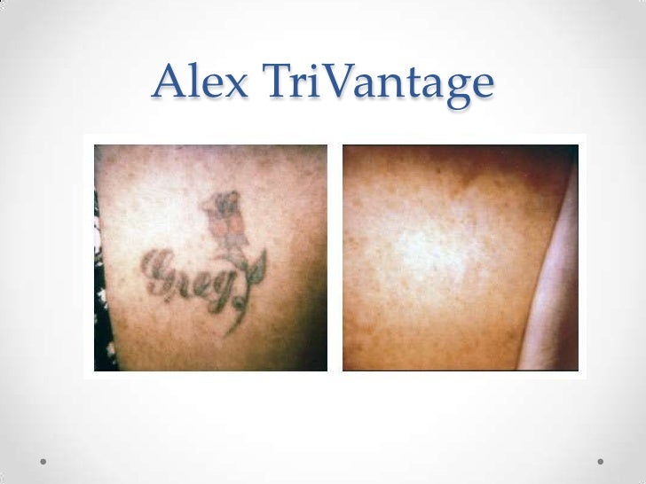 Alex TriVantage Laser Tattoo Brown Spots Orange County, CA