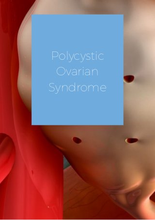 Polycystic
Ovarian
Syndrome
 