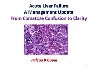 Acute Liver Failure 
A Management Update 
From Comatose Confusion to Clarity 
Palepu B Gopal 
1 
 
