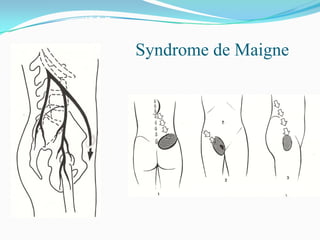 Syndrome de Maigne
 