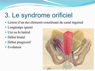 3. Le syndrome orificiel
Lésion d’un des éléments constituant du canal inguinal
Longtemps ignoré
Uni ou bi latéral
Début brutal
Début progressif
Evolution
 