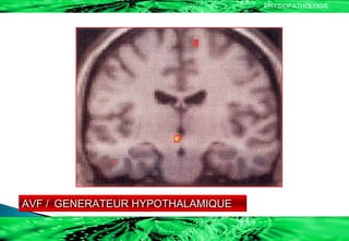 AVF /  GENERATEUR HYPOTHALAMIQUE  PHYSIOPATHOLOGIE 