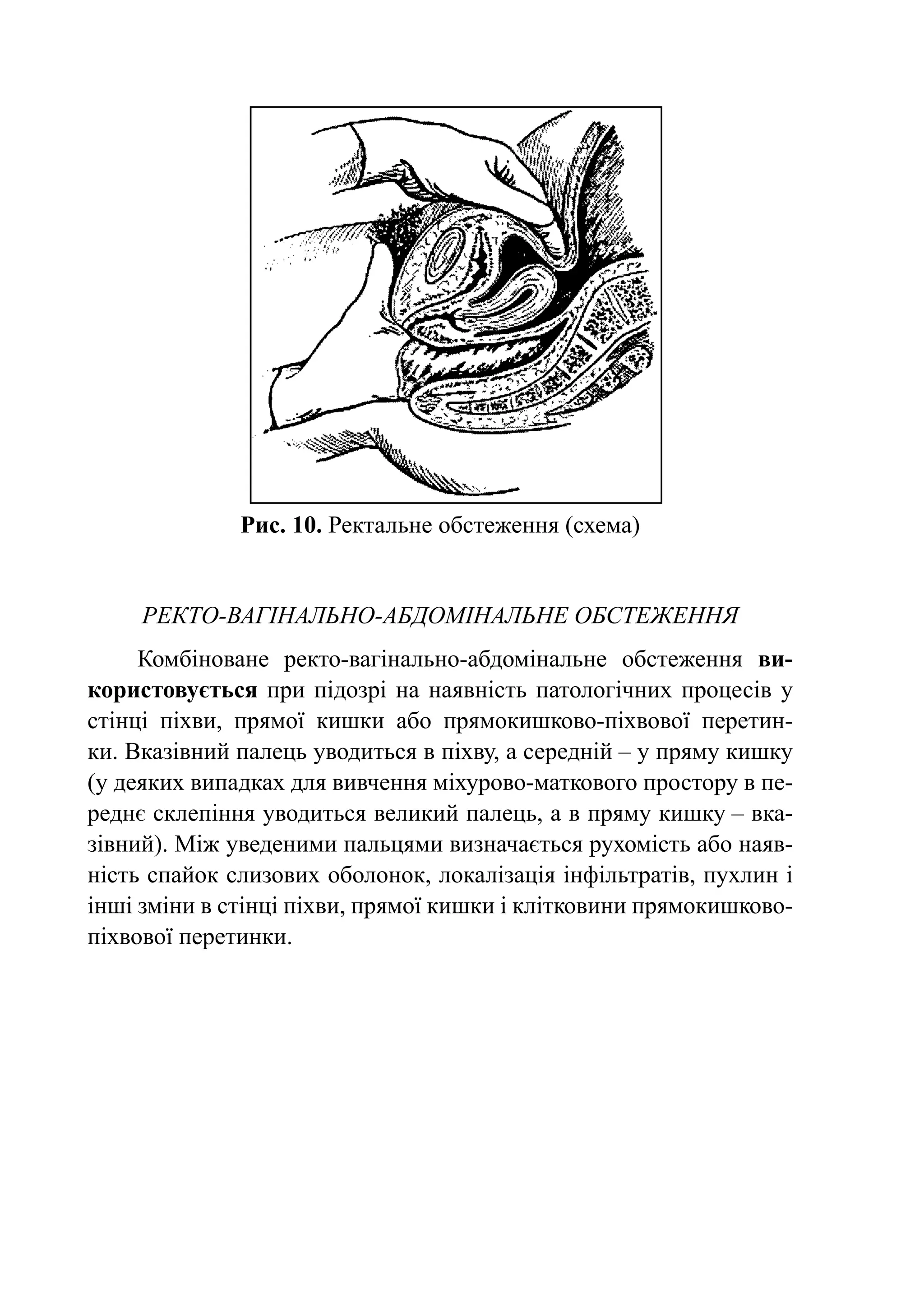 Рис. 10. Ректальне обстеження (схема)


     ректо-вагінально-абдомінальне обстеження
     Комбіноване ректо-вагінально-абдомінальне обстеження ви-
користовується при підозрі на наявність патологічних процесів у
стінці піхви, прямої кишки або прямокишково-піхвової перетин-
ки. Вказівний палець уводиться в піхву, а середній – у пряму кишку
(у деяких випадках для вивчення міхурово-маткового простору в пе-
реднє склепіння уводиться великий палець, а в пряму кишку – вка-
зівний). Між уведеними пальцями визначається рухомість або наяв-
ність спайок слизових оболонок, локалізація інфільтратів, пухлин і
інші зміни в стінці піхви, прямої кишки і клітковини прямокишково-
піхвової перетинки.
 
