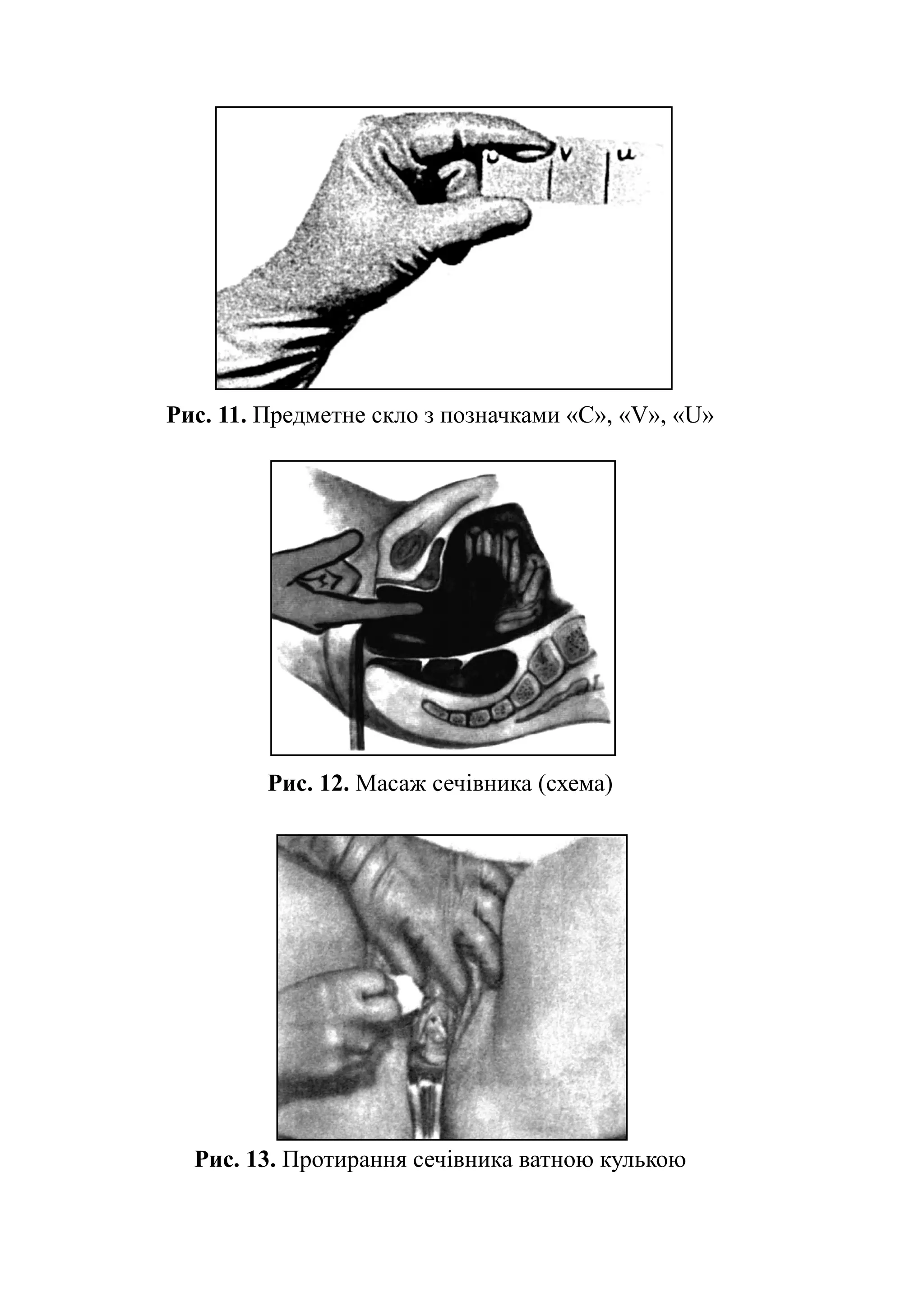 Рис. 11. Предметне скло з позначками «C», «V», «U»




         Рис. 12. Масаж сечівника (схема)




  Рис. 13. Протирання сечівника ватною кулькою
 