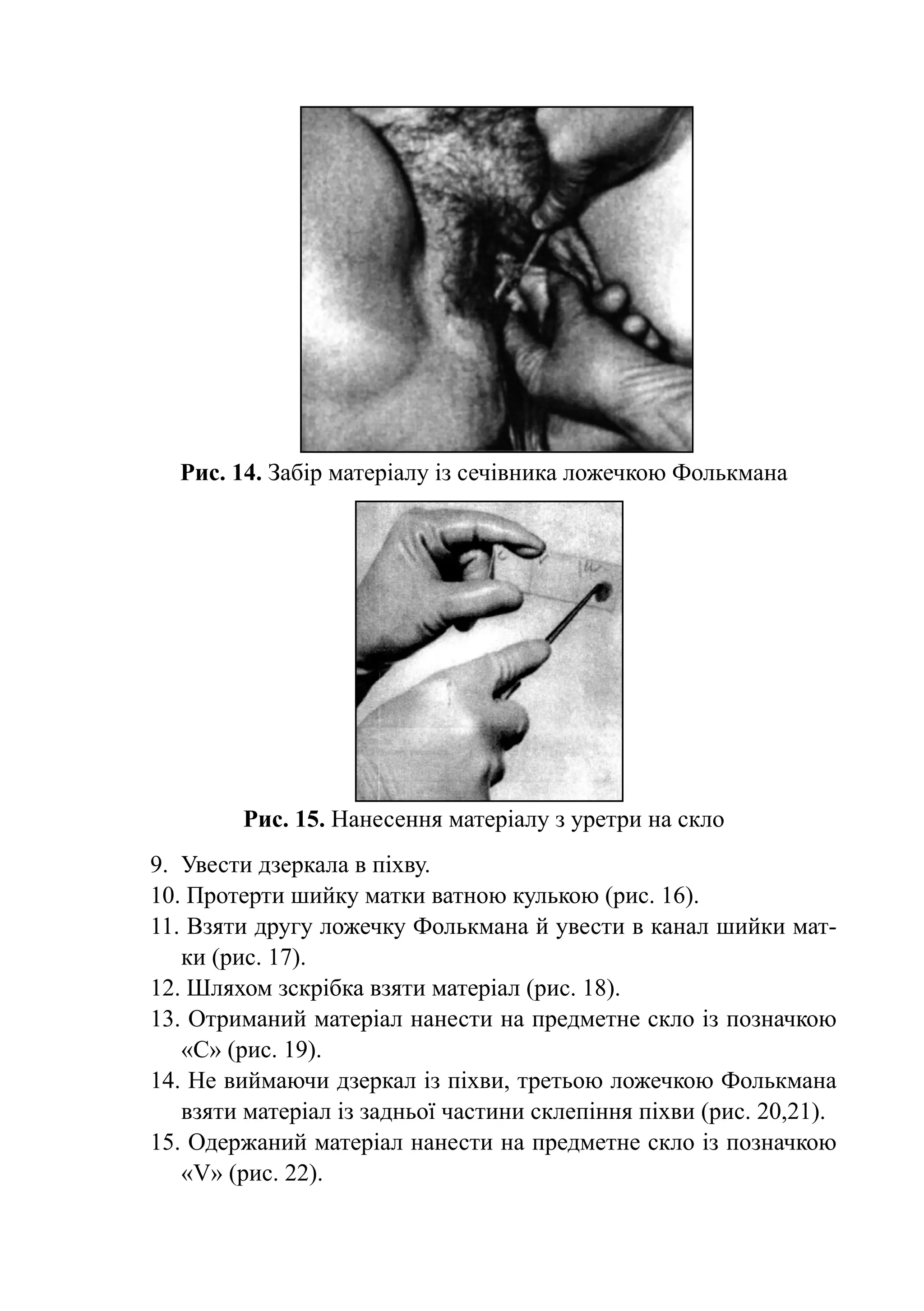 Рис. 14. Забір матеріалу із сечівника ложечкою Фолькмана




         Рис. 15. Нанесення матеріалу з уретри на скло
9.	 Увести дзеркала в піхву.
10. Протерти шийку матки ватною кулькою (рис. 16).
11. Взяти другу ложечку Фолькмана й увести в канал шийки мат-
    ки (рис. 17).
12. Шляхом зскрібка взяти матеріал (рис. 18).
13. Отриманий матеріал нанести на предметне скло із позначкою
    «С» (рис. 19).
14. Не виймаючи дзеркал із піхви, третьою ложечкою Фолькмана
    взя­ и матеріал із задньої частини склепіння піхви (рис. 20,21).
       т
15. Одержаний матеріал нанести на предметне скло із позначкою
    «V» (рис. 22).
 