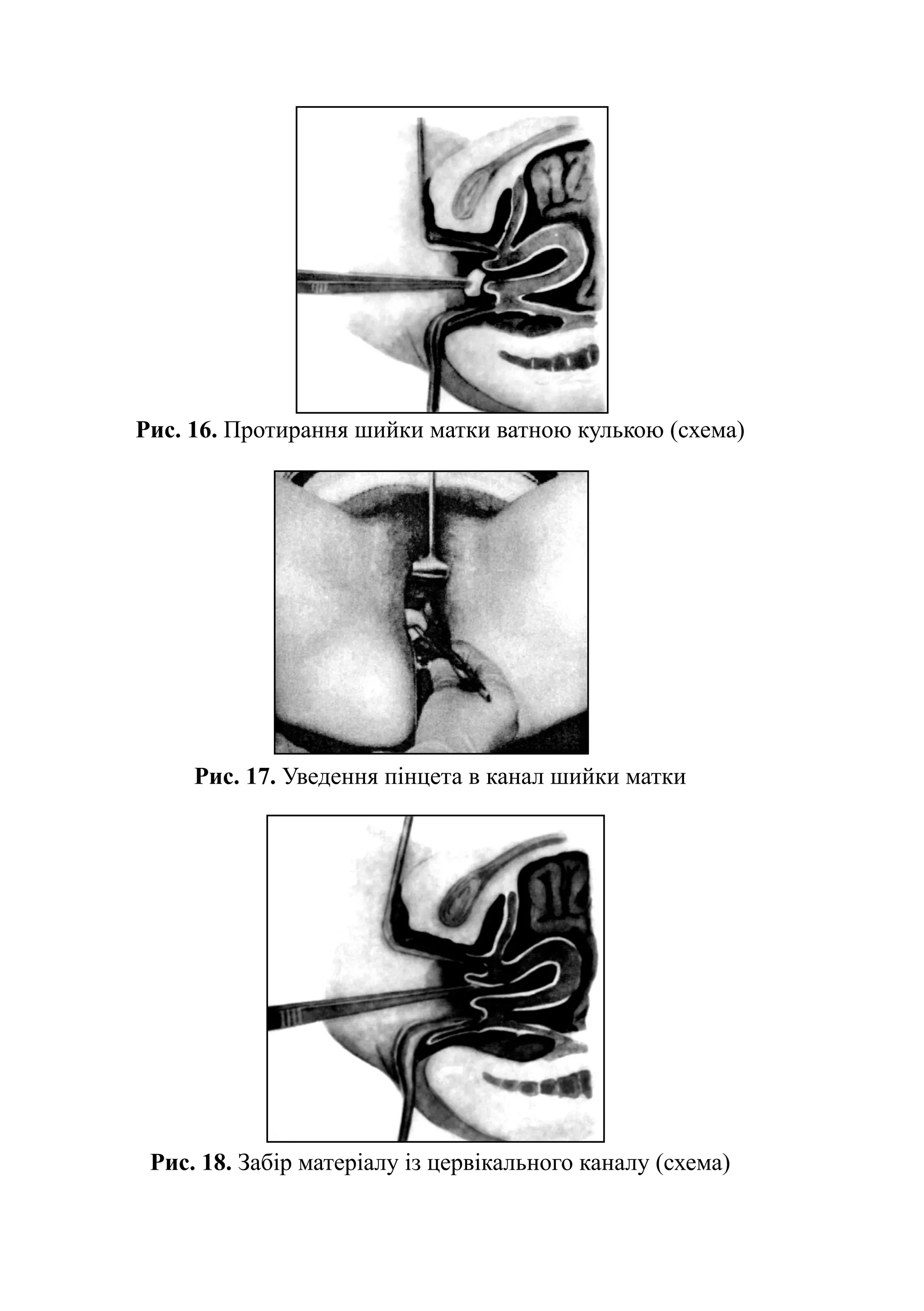 Рис. 16. Протирання шийки матки ватною кулькою (схема)




     Рис. 17. Уведення пінцета в канал шийки матки




 Рис. 18. Забір матеріалу із цервікального каналу (схема)
 