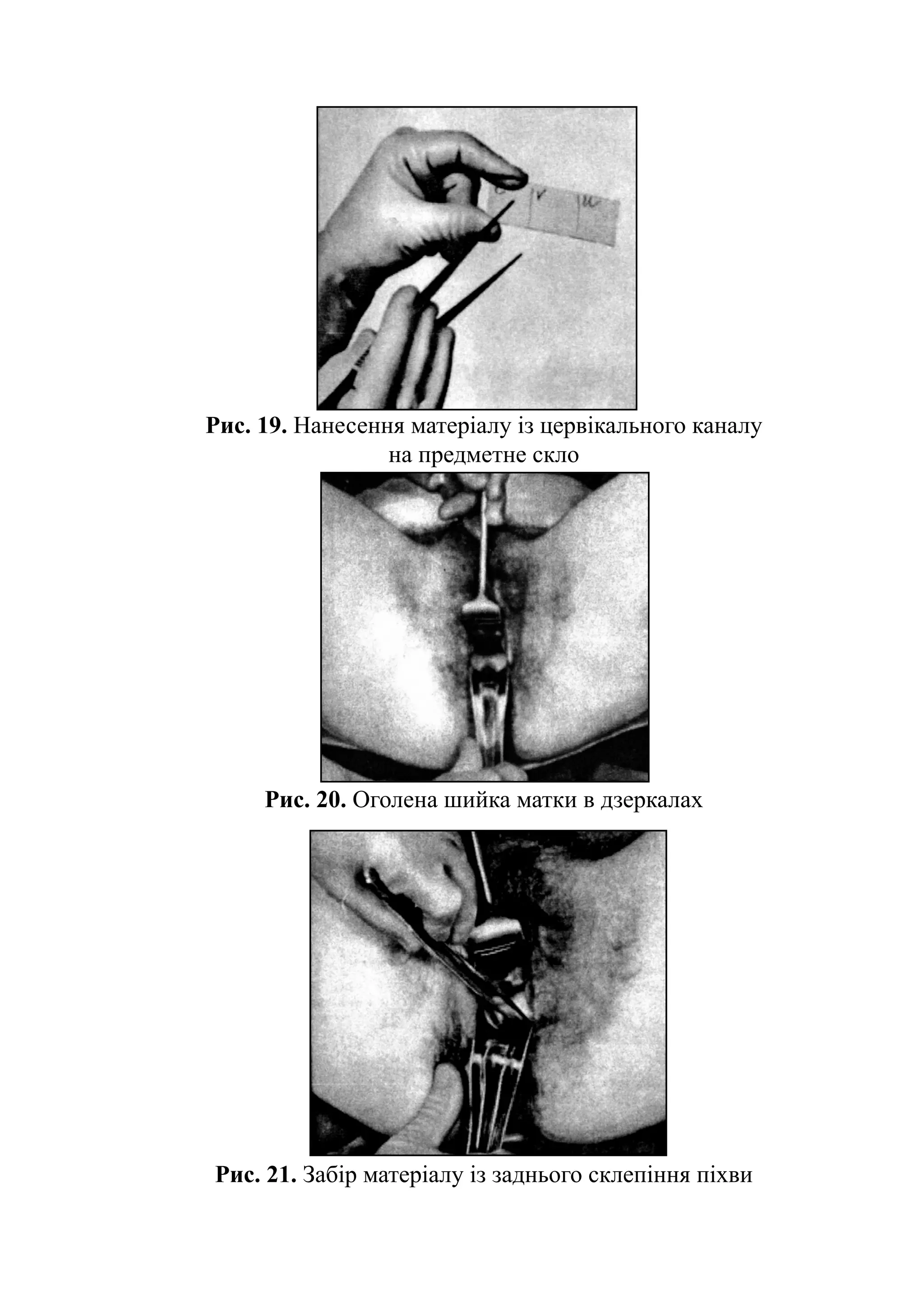 Рис. 19. Нанесення матеріалу із цервікального каналу
                 на предметне скло




     Рис. 20. Оголена шийка матки в дзеркалах




Рис. 21. Забір матеріалу із заднього склепіння піхви
 