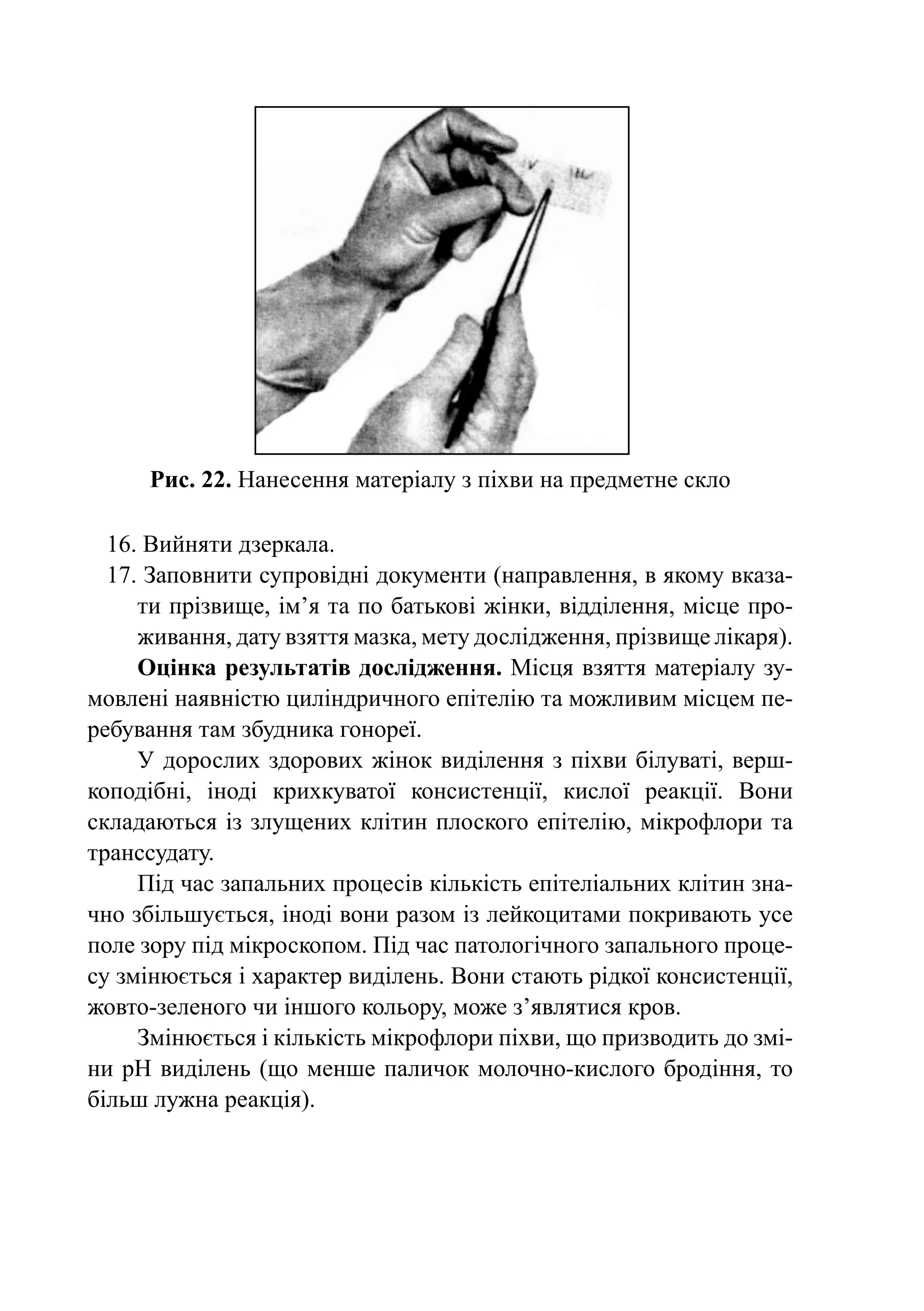 Рис. 22. Нанесення матеріалу з піхви на предметне скло

  16. Вийняти дзеркала.
  17. Заповнити супровідні документи (направлення, в якому вказа­
     ти прізвище, ім’я та по батькові жінки, відділення, місце про­­­­
     живання, дату взяття мазка, мету дослідження, прізвище лі­ аря).
                                                              к
     Оцінка результатів дослідження. Місця взяття матеріалу зу-
мовлені наявністю циліндричного епітелію та можливим місцем пе-
ребування там збудника гонореї.
     У дорослих здорових жінок виділення з піхви білуваті, верш-
коподібні, іноді крихкуватої консистенції, кислої реакції. Вони
складаються із злущених клітин плоского епітелію, мікрофлори та
транссудату.
     Під час запальних процесів кількість епітеліальних клітин зна-
чно збільшується, іноді вони разом із лейкоцитами покривають усе
поле зору під мікроскопом. Під час патологічного запального проце-
су змінюється і характер виділень. Вони стають рідкої консистенції,
жовто-зеленого чи іншого кольору, може з’являтися кров.
     Змінюється і кількість мікрофлори піхви, що призводить до змі-
ни рН виділень (що менше паличок молочно-кислого бродіння, то
більш лужна реакція).
 