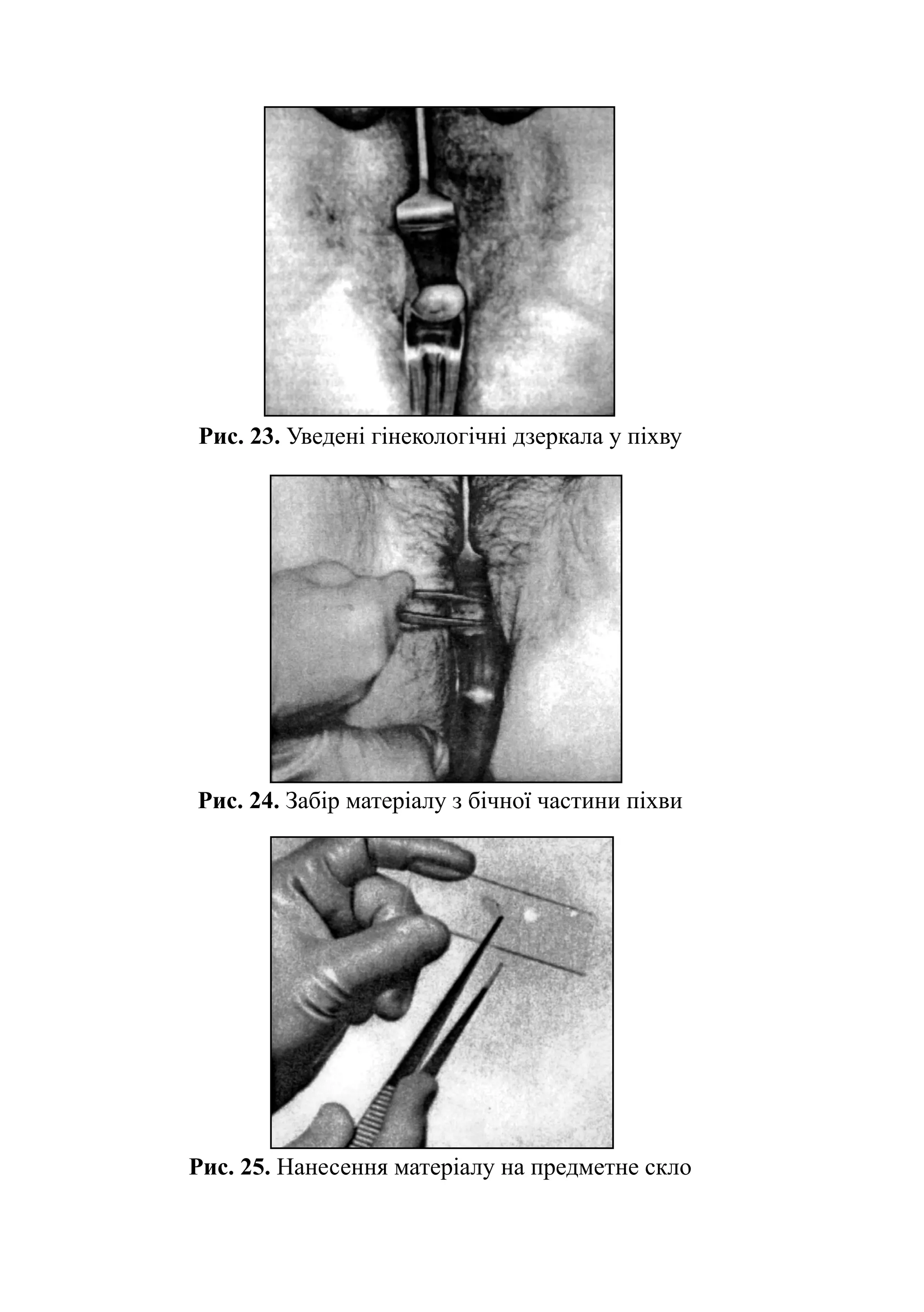 Рис. 23. Уведені гінекологічні дзеркала у піхву




Рис. 24. Забір матеріалу з бічної частини піхви




Рис. 25. Нанесення матеріалу на предметне скло
 