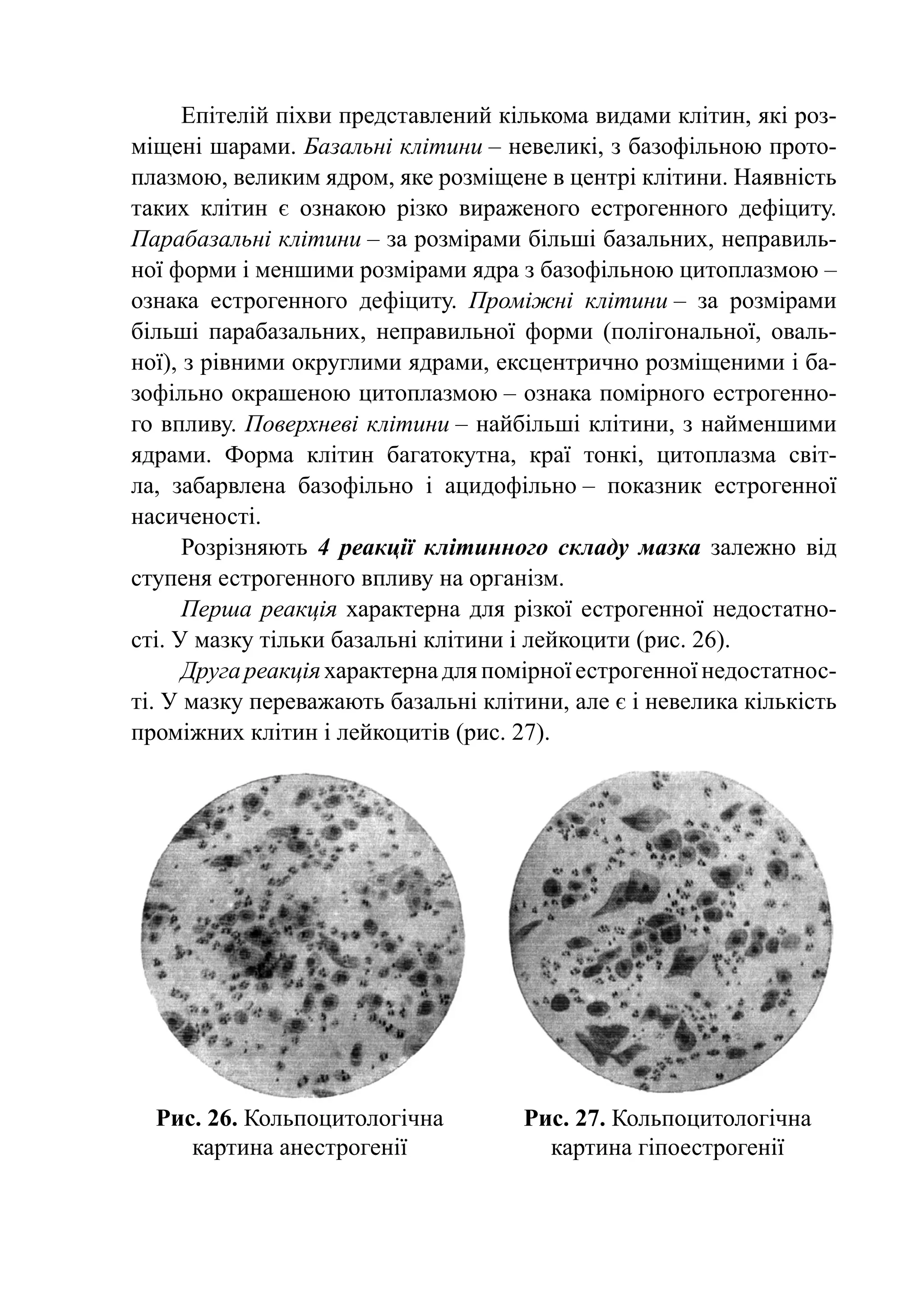 Епітелій піхви пред­ тав­ е­ ий кіль­ ома видами клітин, які роз­­
                          с л н           к
мі­ ені шарами. Базальні клі­ и­ и – не­ еликі, з базофільною про­ о­
   щ                          т н        в                          т
плаз­ ою, великим ядром, яке розміщене в центрі клітини. Наяв­ ість
     м                                                            н
таких клітин є ознакою різко вираженого естрогенного дефіциту.
Парабазальні клітини – за розмірами більші базальних, неправиль-
ної форми і меншими розмірами ядра з базофільною цитоплазмою –
ознака естрогенного дефіциту. Проміжні клітини – за розмірами
більші парабазальних, неправильної форми (по­ і­ о­ аль­ ої, оваль-
                                                   лг н н
ної), з рівними округлими ядрами, ексцентрично розміщеними і ба-
зофільно окрашеною цитоплазмою – ознака помірного естрогенно-
го впливу. Поверхневі клітини – найбільші клітини, з найменшими
ядрами. Форма клітин багатокутна, краї тонкі, цитоплазма світ-
ла, забарвлена базофільно і ацидофільно – показник естрогенної
насиченості.
      Розрізняють 4 реакції клітинного складу мазка залежно від
ступеня естрогенного впливу на організм.
      Перша реакція характерна для різкої естрогенної недо­ тат­ о­
                                                               с н
сті. У мазку тільки базальні клітини і лейкоцити (рис. 26).
      Друга реакція характерна для помірної естрогенної недостатнос­
ті. У мазку переважають базальні клітини, але є і невелика кількість
проміжних клітин і лейкоцитів (рис. 27).




  Рис. 26. Кольпоцитологічна            Рис. 27. Кольпоцитологічна
     картина анестрогенії                 картина гіпоестрогенії
 