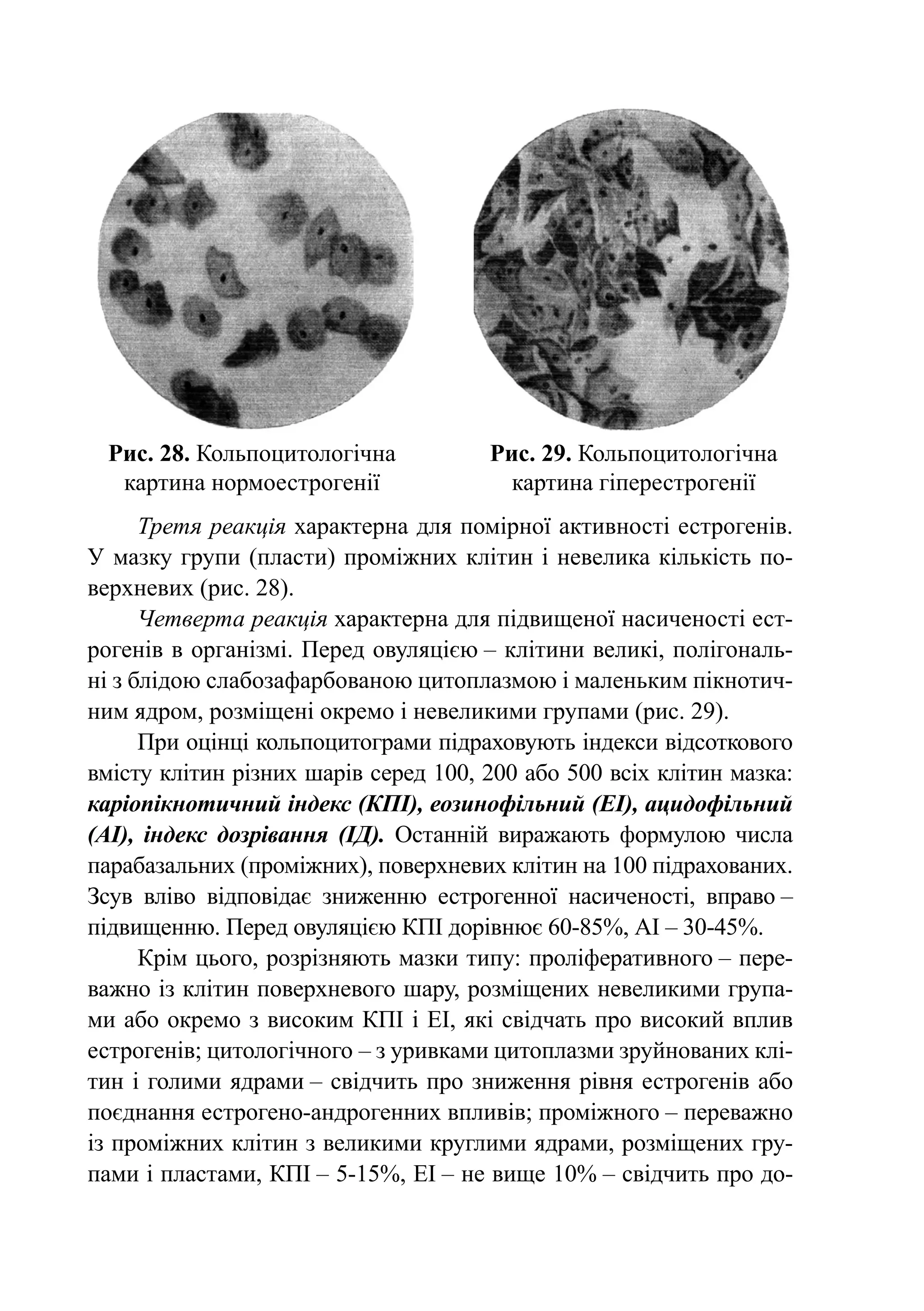 Рис. 28. Кольпоцитологічна           Рис. 29. Кольпоцитологічна
   картина нормоестрогенії               картина гіперестрогенії
      Третя реакція харак­­ на для помірної ак­ ив­ ос­ і естрогенів.
                           тер­                   т н т
У мазку гру­ и (пласти) проміжних клі­ ин і невелика кількість по­
              п                          т
верхневих (рис. 28).
      Четверта реакція ха­ ак­­
                            р терна для підвищеної насиченості ест­
ро­ енів в організмі. Перед овуляцією – клітини великі, полігональ­
   г
ні з блідою слабозафарбованою цитоплазмою і маленьким пікнотич-
ним ядром, розміщені окремо і невеликими групами (рис. 29).
      При оцінці кольпоцитограми підраховують індекси від­ от­ о­ о­ о
                                                             с к в г
вмісту клітин різних шарів серед 100, 200 або 500 всіх клітин мазка:
каріо­ ік­ о­ ич­ ий індекс (КПІ), еозино­ іль­ ий (ЕІ), ацидофільний
      п н т н                            ф н
(АІ), індекс дозрівання (ІД). Остан­ ій виражають формулою числа
                                      н
парабазальних (проміжних), поверхневих клітин на 100 під­ а­ ованих.
                                                            р х
Зсув вліво відповідає зни­ енню естрогенної на­ и­­
                            ж                      с ченості, вправо –
підвищенню. Перед овуляцією КПІ дорівнює 60‑85%, АІ – 30-45%.
      Крім цього, розрізняють мазки типу: проліферативного – пере-
важно із клітин поверхневого шару, розміщених невеликими група-
ми або окремо з високим КПІ і ЕІ, які свідчать про високий вплив
естрогенів; цитологічного – з уривками цитоплазми зруйнованих клі-
тин і голими ядрами – свідчить про зниження рівня естрогенів або
поєднання естрогено-андрогенних впливів; про­ іж­ о­ о – переважно
                                                 м н г
із проміжних клітин з великими круглими ядрами, розміщених гру-
пами і пластами, КПІ – 5-15%, ЕІ – не вище 10% – свідчить про до-
 